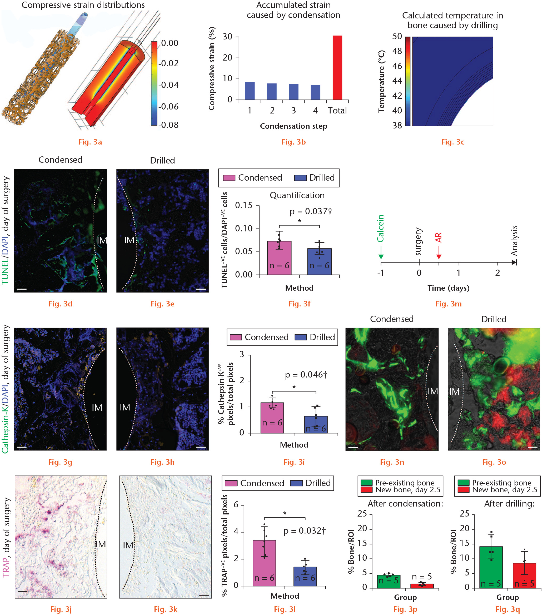 Fig. 3 
            Condensation creates high interfacial strain, which triggers osteocyte death and bone resorption. a) A representative image of the pattern and magnitude of the compressive strain distributions followed by its gradual enlargement by condensation. b) Graph showing accumulated strain caused by condensation. c) Computational model of heat transfer by the drilling protocol. d) to f) terminal deoxynucleotidyl transferase dUTP nick end labelling (TUNEL) staining on representative tissue sections from d) a case where the implant was placed into condensed bone versus e) a case where the implant was placed into drilled bone on the day of surgery, quantified in f) dotted line represents bone-implant interface. g) to i) Cathepsin-K expression on representative tissue sections from g) a case where the implant was placed into condensed group and h) a case where the implant was placed into drilled group on the day of surgery, quantified in i) dotted line represents bone-implant interface. j) to l) TRAP activity on representative tissue sections from j) a case where the implant was placed into condensed bone versus k) a case where the implant was placed into drilled bone on the day of surgery, quantified in l) dotted line represents bone-implant interface. m) Schematic demonstrating the experimental strategy of labelling analysis using Calcein and Alizarin Red (AR). n) and o) Calcein (green, labelling the previously existing trabecular bone) and AR (red, labelling the newly formed bone) labelling analysis on representative transverse tissue sections in peri-implant region in a n) condensation specimen and o) drilled specimen. p) and q) Quantification of pre-existing (green) and new peri-implant (red) bone following p) condensation or q) drilling. Scale bars = 50 µm. *p < 0.05. †Paired t-test. IM, implant; ROI, region of interest; TRAP, tartrate-resistant acid phosphatase.
          