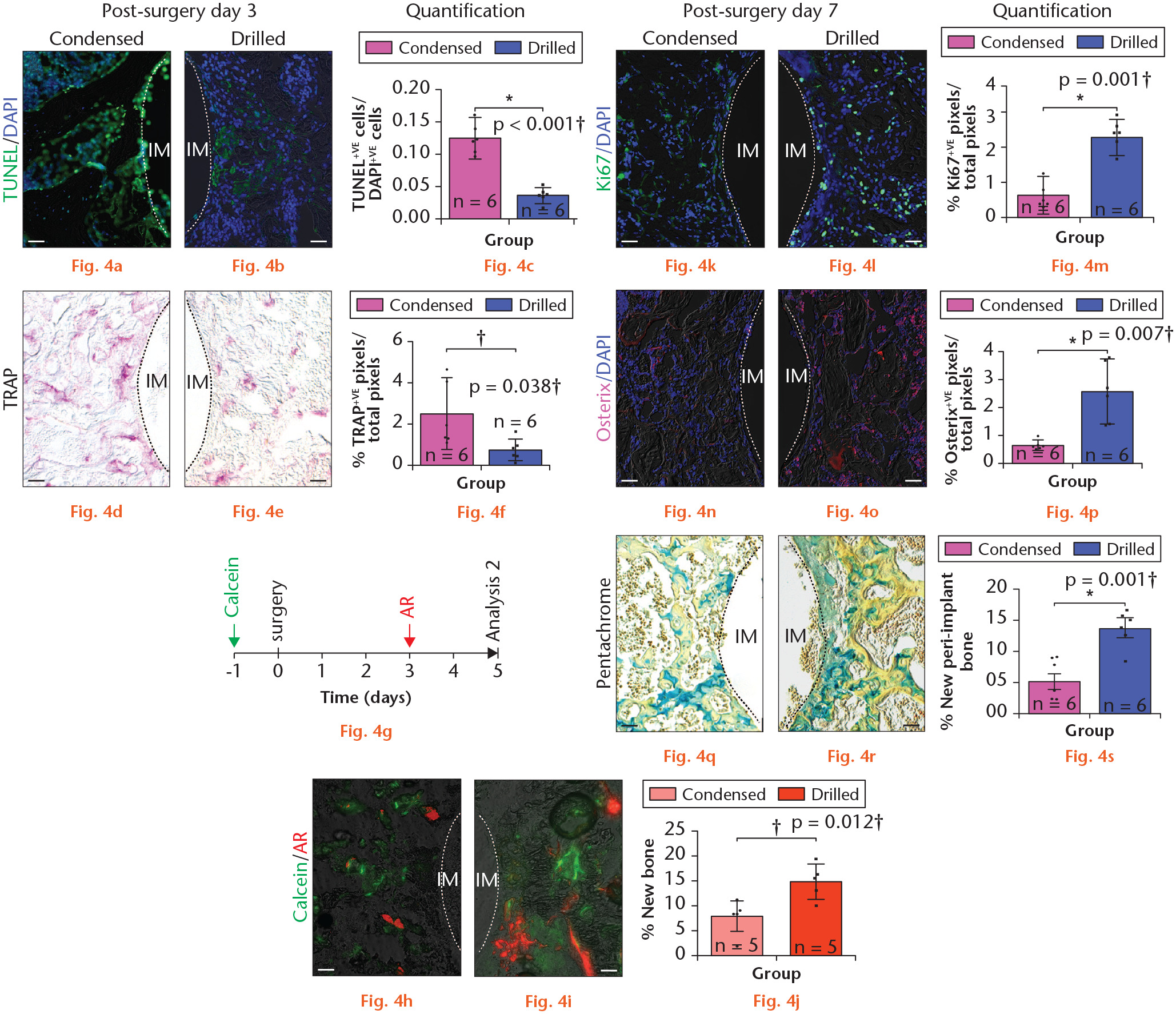 Fig. 4 
            Condensation delays new peri-implant bone formation. a) and b) terminal deoxynucleotidyl transferase dUTP nick end labelling (TUNEL) staining, demonstrating cell apoptosis, on representative transverse tissue sections on post-surgery day (PSD) 3 in a) a case where the implant was placed into condensed bone versus b) a case where the implant was placed into drilled bone. The dotted line represents the bone-implant interface. c) Quantification comparing the ratio of TUNEL-positive with DAPI-positive cells in peri-implant bone following condensation (pink) or drilling (blue). d) to f) TRAP activity on representative tissue sections from d) a case where the implant was placed into condensed bone versus e) a case where the implant was placed into drilled bone on PSD 3, quantified in f). Dotted line represents bone-implant interface. g) Schematic demonstrating the experimental strategy of labelling analysis using Calcein and Alizarin Red (AR). h) and i) Calcein (green, labelling the previously existing trabecular bone) and AR (red, labelling the newly formed bone) labelling analysis on representative transverse tissue sections in peri-implant region from h) a case where the implant was placed into condensed bone versus i) a case where the implant was placed into drilled bone. j) Percentage of new bone in condensation (salmon pink) and drilled (red) groups. k) to m) On PSD 7, the peri-implant region in the k) condensed specimen has fewer Ki67-positive cells compared with that in the l) drilled specimen; quantified in m). n) to p) Similarly, Osterix activity on PSD 7 is lower in the n) condensed specimen compared with in the o) drilled specimen; quantified in p). q) and r) Pentachrome in q) the peri-implant region of a condensed specimen versus r) the peri-implant region of a drilled specimen. s) Quantification of new peri-implant bone in condensed (pink) and drilled (blue) groups. Scale bars = 50 µm. *p < 0.01; †Paired t-test. §p < 0.05. IM, implant; TRAP, tartrate-resistant acid phosphatase.
          