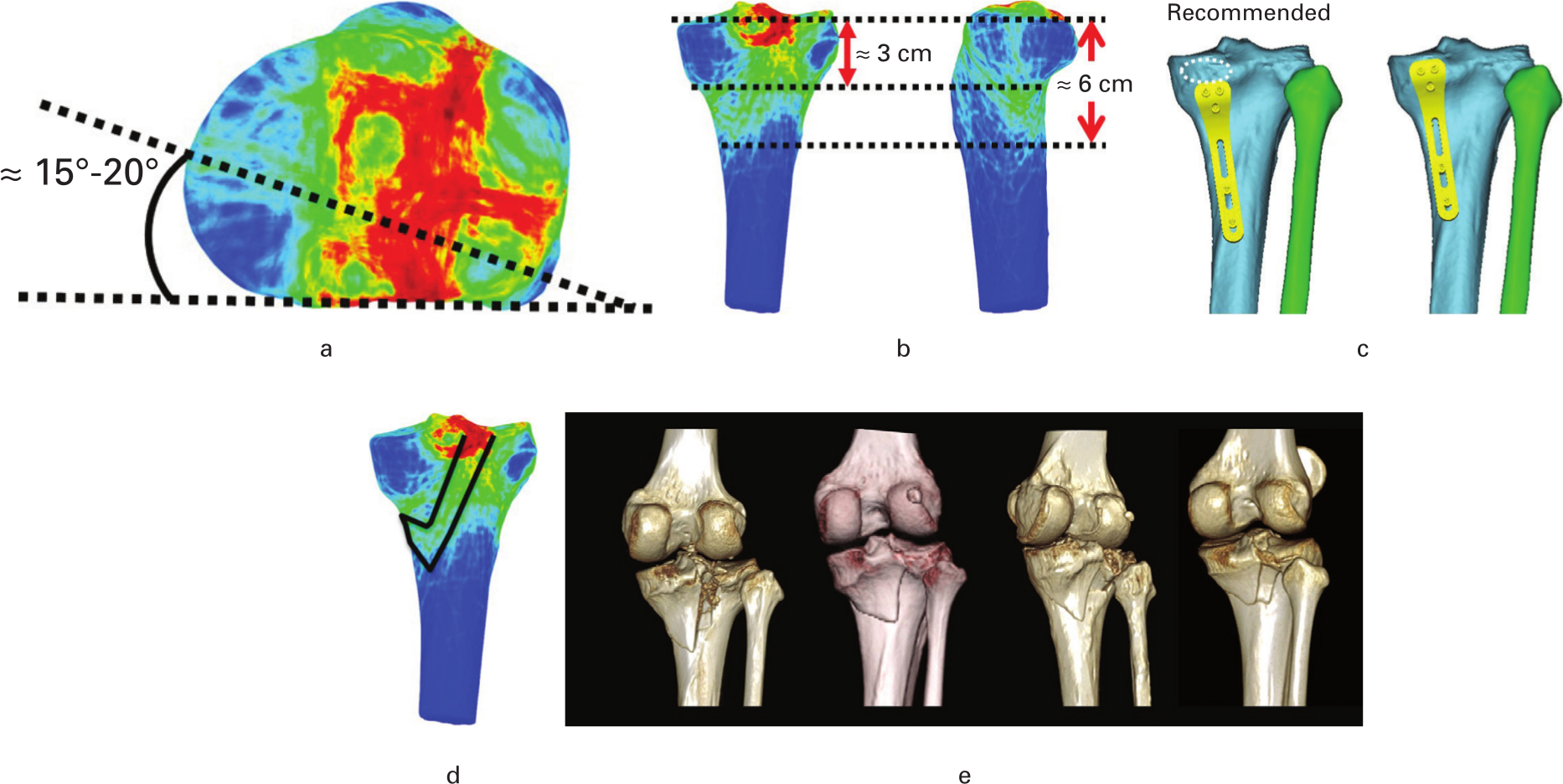 Fig. 4 
            a) Fracture angle between the line of posteromedial fragment and the posterior condylar axis was approximately 15° to 20° in the axis view. b) The distance from the articular surface was approximately 3 cm to the fracture line compact area and 6 cm to the acute vertex. c) The recommended location of the posteromedial plate. The white circle represents the insertion of the semimembranosus. d) Fracture line band, ‘spur’ sign indicated the presence of a classic flexion injury, as shown by the black line. e) Specific cases of the ‘spur’ sign.
          