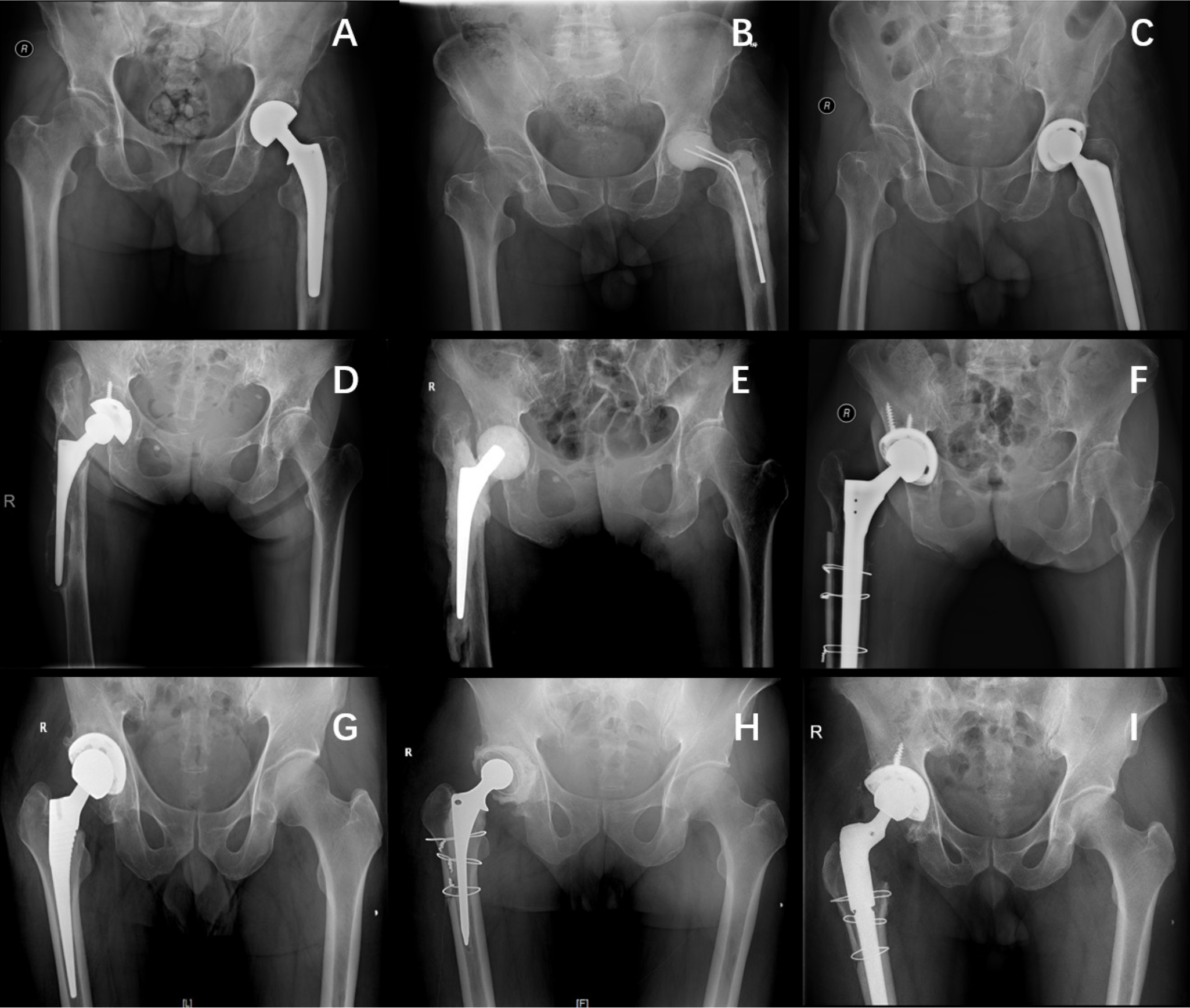 Fig. 2 
            Typical cases in three groups. a) to c) Two Kirschner wires as endoskeleton of spacer in group I. d) to f) A small prosthesis as endoskeleton of molded spacer in group II. g) to i) Cemented prosthesis as spacer in group III.
          