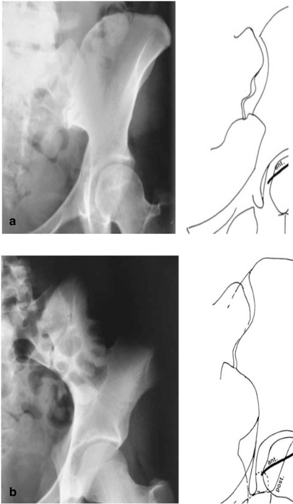 Fig. 3 
            a) In a normal acetabulum, the line outlining the edge of the anterior rim always lies medial to the line outlining the posterior rim and the line of the edge of the posterior wall descends laterally or through the centre of the femoral head. b) In a retroverted acetabulum, there is an overlap of the two lines (‘crossover sign’) and the line outlining the posterior rim descends medially (‘absent posterior wall’).
          