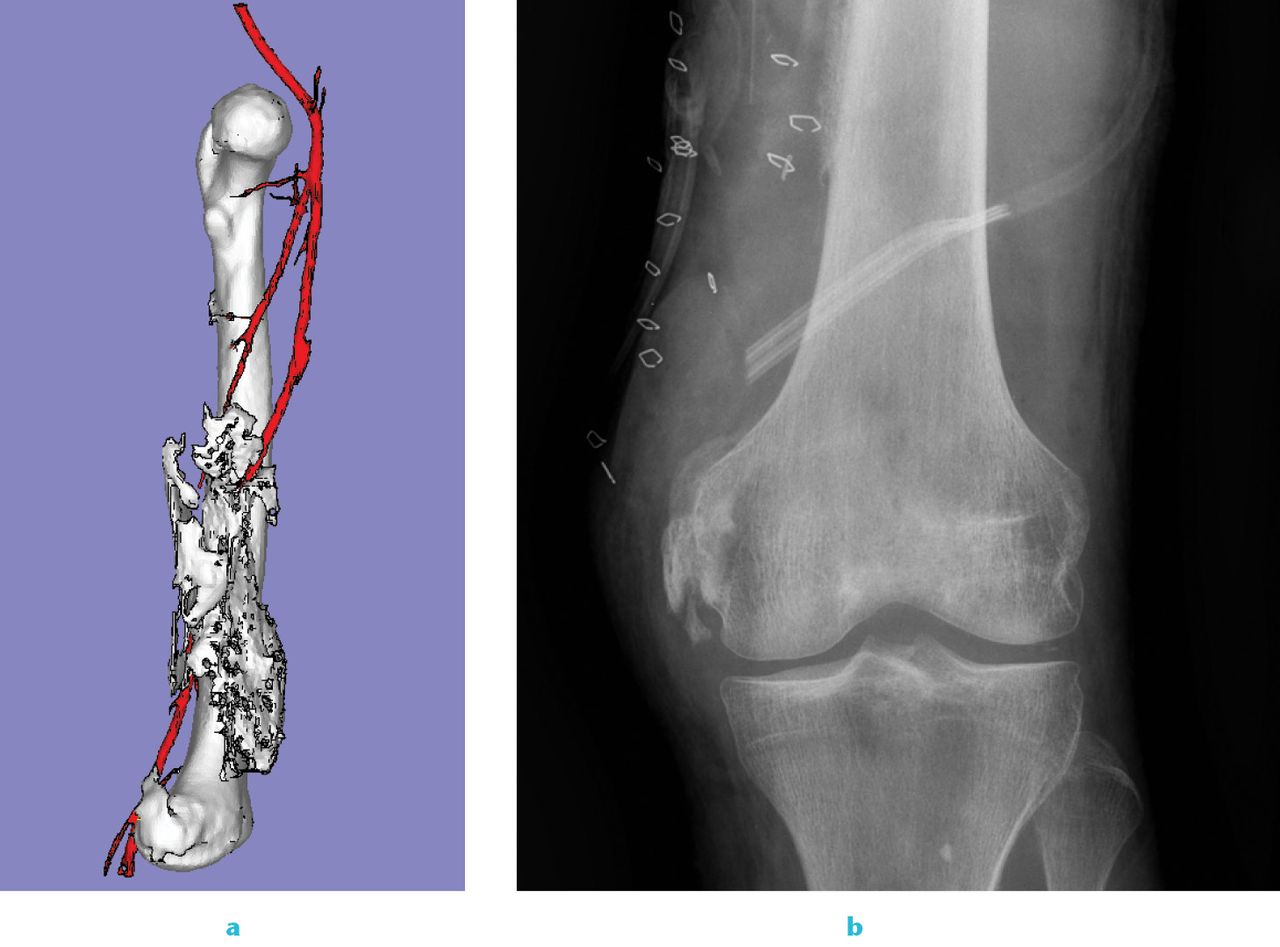 Fig. 4 
          
            Figure 4a – three-dimensional CT scan reconstruction of a patient with severe heterotopic ossification (HO) incarcerating his superficial femoral vessels and severely limiting the range of movement of his knee because of quadriceps and adductor involvement, resulting in secondary arthrofibrosis. The patient was neurovascularly intact distally in this otherwise sound limb, and underwent successful excision of the HO and lysis of knee adhesions without injury to the entrapped vessels. Figure 4b – post-operative anteroposterior radiograph of this patient’s distal femur and knee.
        