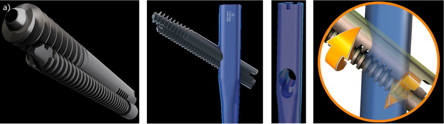 Fig. 4 
            Images showing Smith & Nephew components; a) INTERTAN  Integrated Screws; b) INTERTAN  Nail with Integrated Screws; c) INTERTAN  Nail Proximal Profile and d) INTERTAN  Integrated Screw Compression Mechanism (images reproduced with permission from Smith & Nephew).
          