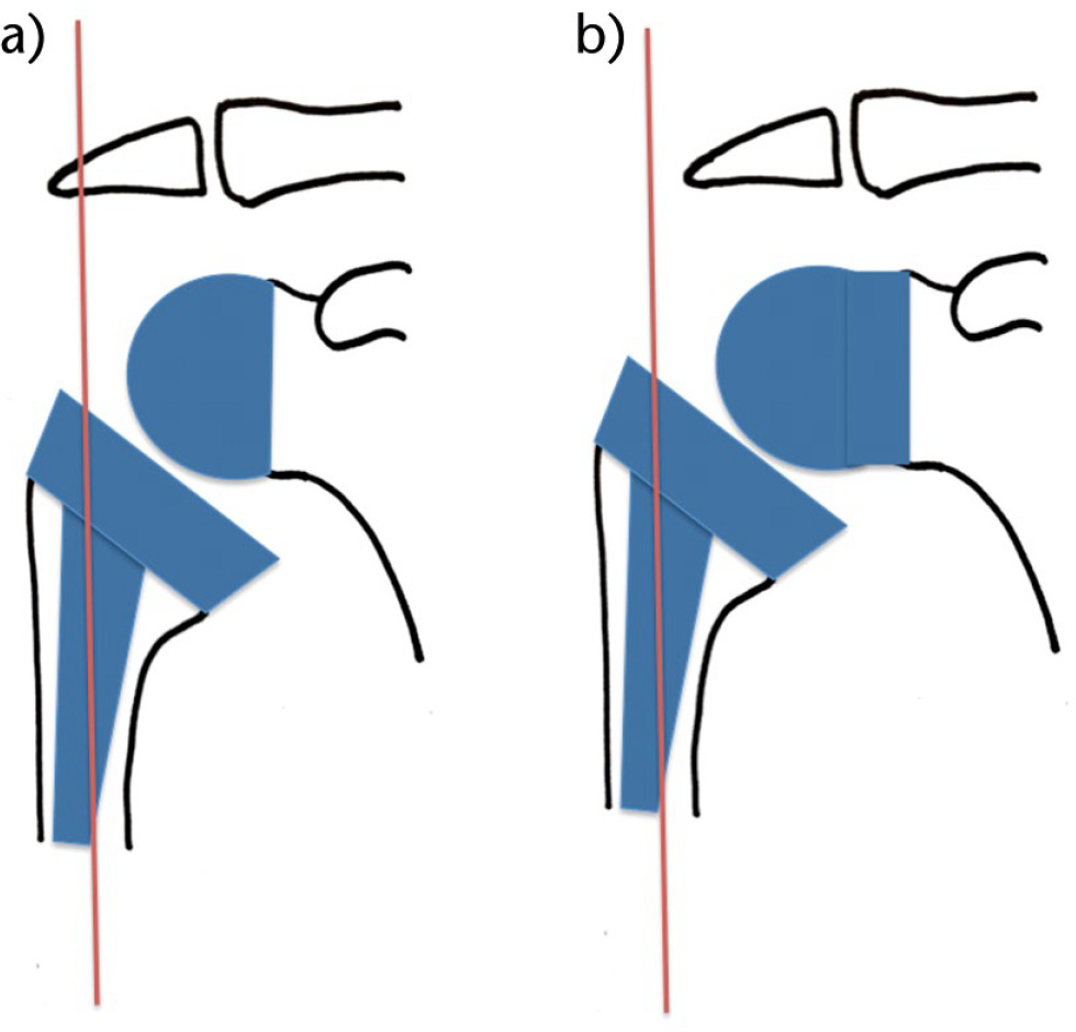 Fig. 3a and 3b 
          Medialised and lateralised designs – schematic
        