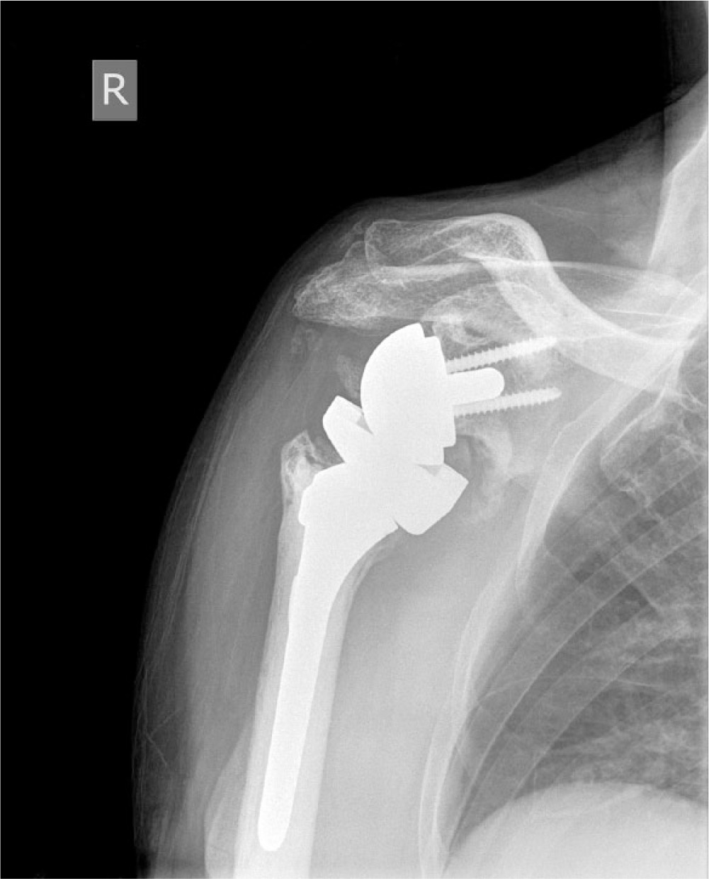 Fig. 4 
          Glenoid neck notching
        