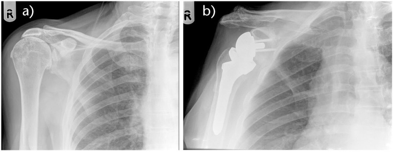 Fig. 5a and 5b 
          Reverse prosthesis for cuff tear arthropathy
        