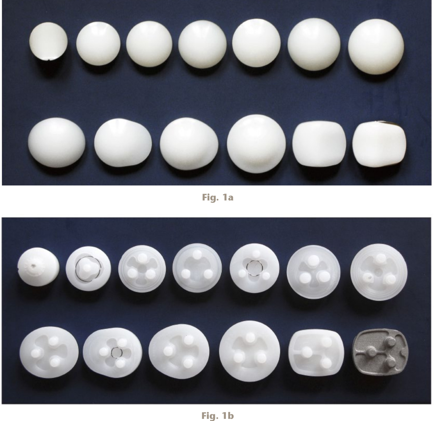 Fig. 1 
          A selection of commercially available patellar components. a) Articulating surface and b) retro-patellar surface. Top row of a) and b), from left to right: Medial Rotation Knee (MRK; Finsbury Orthopaedics, Leatherhead, Surrey, United Kingdom); Genesis II (biconvex; Smith & Nephew, London, United Kingdom); Vanguard (Zimmer Biomet, Warsaw, Indiana); Optetrak (Exactech, Gainesville, Florida); Genesis II dome (Smith & Nephew); Advance Medial-Pivot (Wright Medical Group, Staines-upon-Thames, United Kingdom); Anatomical Graduated Component, (AGC; Zimmer Biomet). Bottom row of a) and b), from left to right: PFC-Sigma (DePuy Synthes, Warsaw, Indiana); Journey (offset dome; Smith & Nephew); Triathlon (offset dome; Stryker); Triathlon (sombrero; Stryker); Low Contact Stress (LCS) all polyethylene (DePuy Synthes); LCS rotating platform (DePuy Synthes). Figure reproduced with the kind permission of Mr Oliver Schindler, FRCS(Orth), Bristol Hip & Knee Clinic, Chesterfield Hospital, Bristol, United Kingdom. Schindler OS. Basic kinematics and biomechanics of the patello-femoral joint. Part 2: The patella in total knee arthroplasty. Acta Orthop Belg 2012;78:11-29.
        