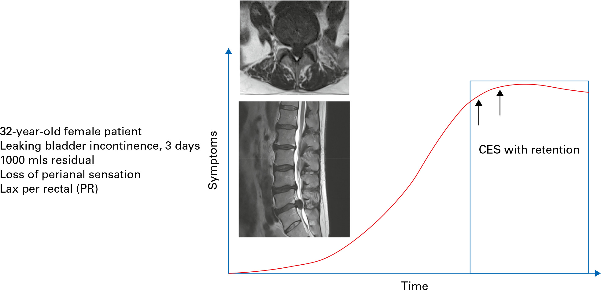 Fig. 4 
          Progression of cauda equina syndrome (CES) symptoms with time for a patient with CES with urinary retention.
        