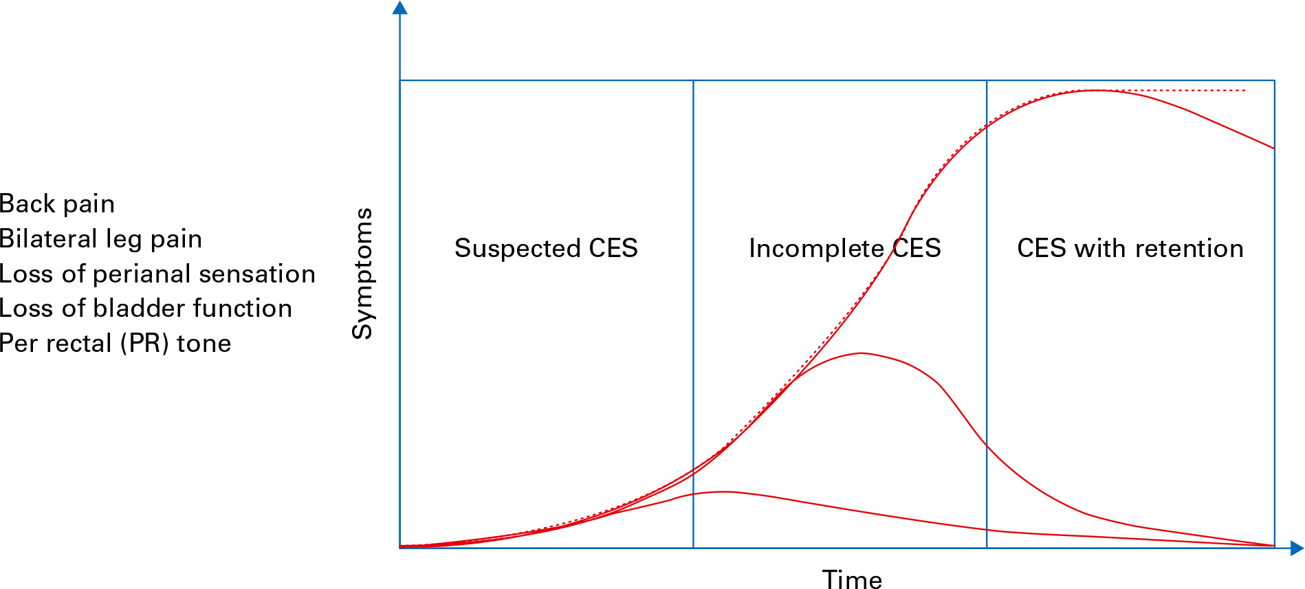 Fig. 5 
          Progression of cauda equina syndrome (CES) symptoms with time for patient with suspected CES, incompleted CES, and CES with urinary retention.
        