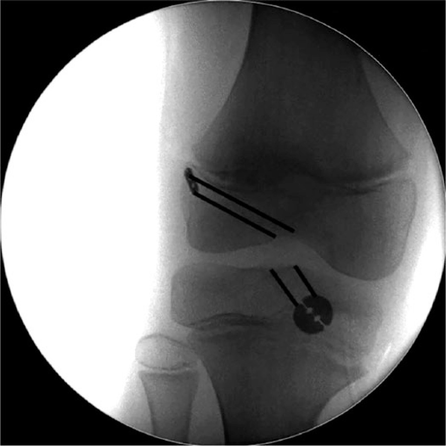 Fig. 3 
          All-epiphyseal reconstruction (lines demarcate tunnel positions).
        