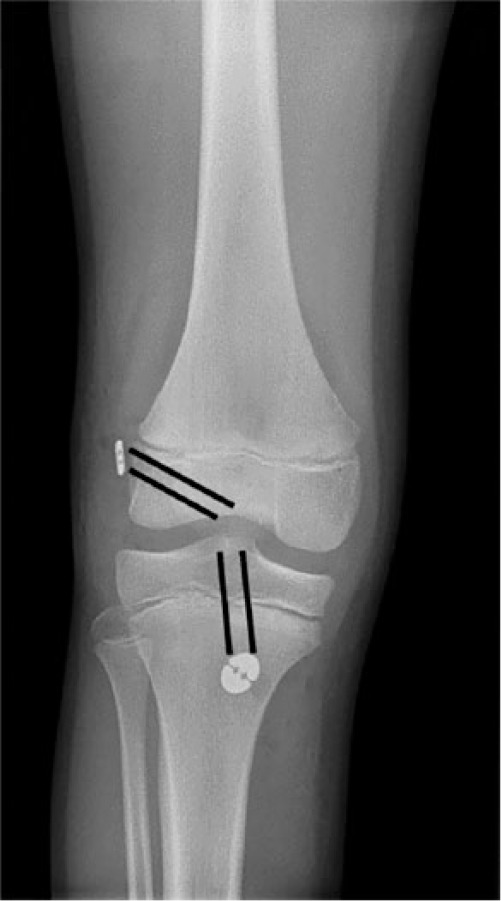 Fig. 4 
          Partial physeal sparing reconstruction (lines demarcate tunnel positions).
        