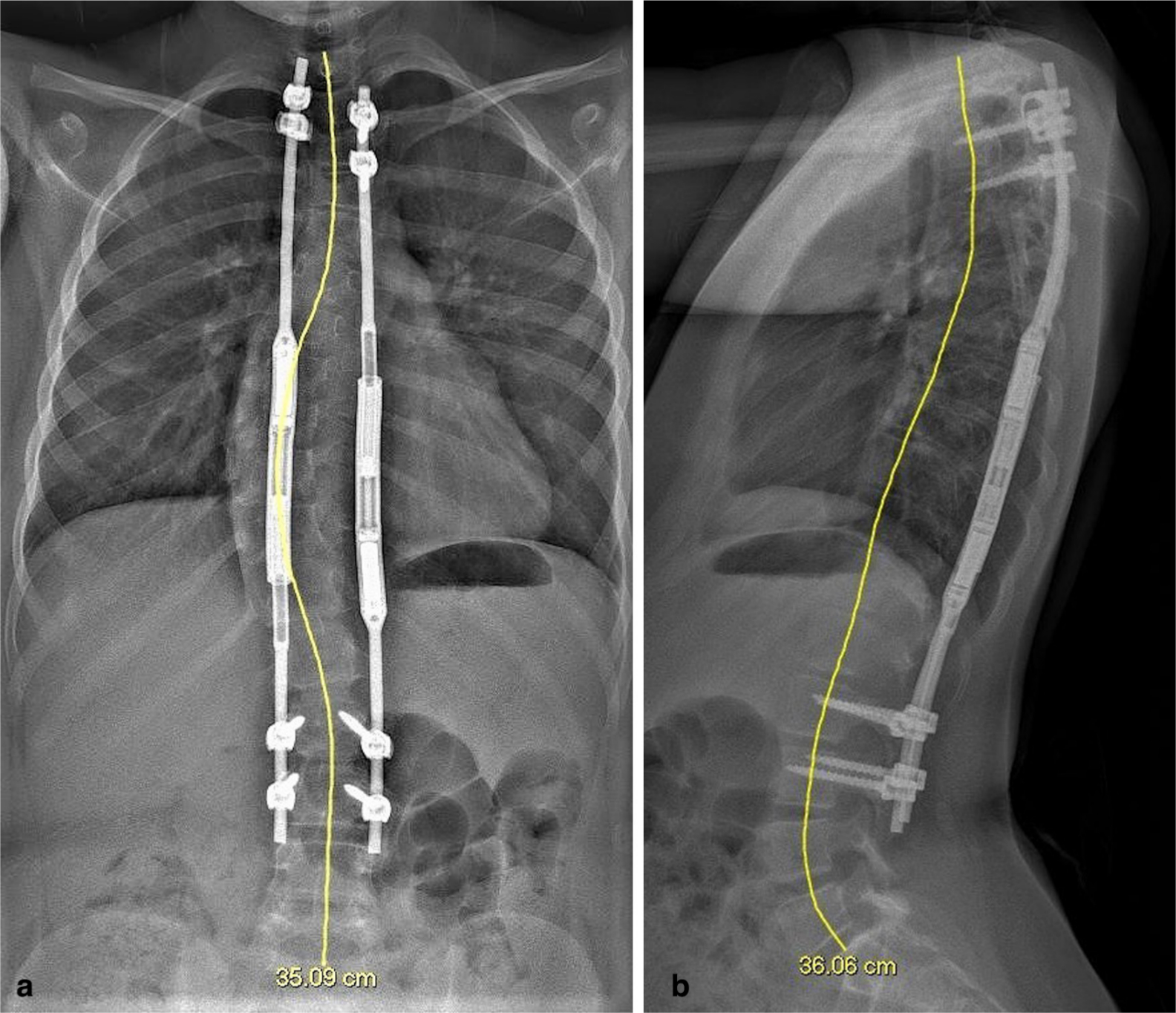 Fig. 2 
            a) Postoperative coronal view radiograph with T1-S1 measurement. b) Postoperative sagittal view radiograph with T1-S1 measurement.
          