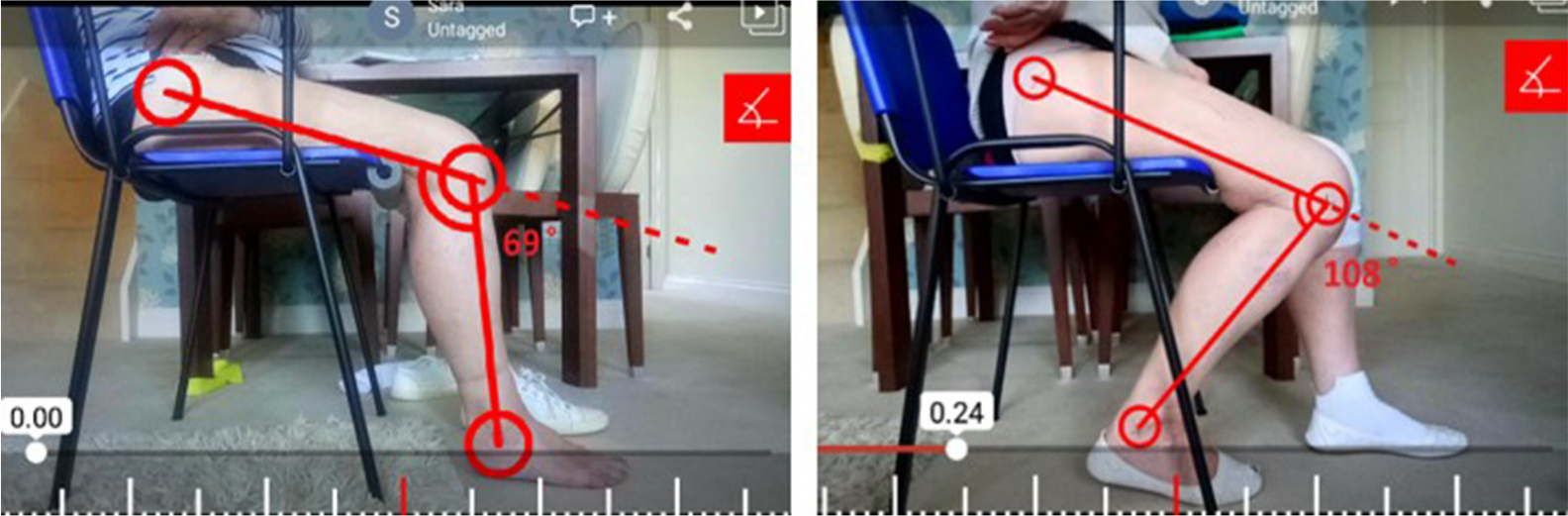 Fig. 3 
            Patient ROM measured by Hudl Ubersense smartphone app.
          