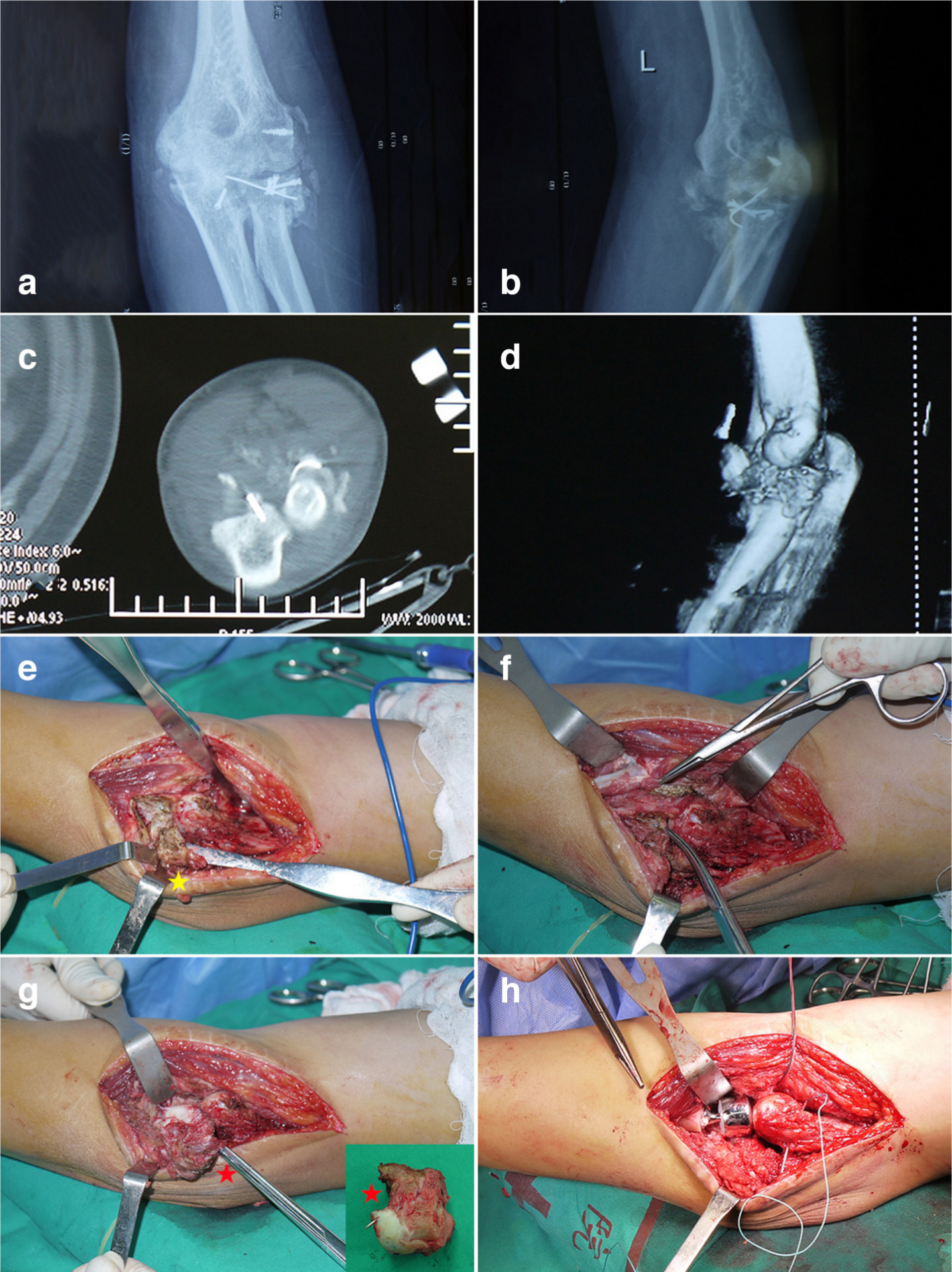 Fig. 3 
            Rotational function reconstruction. a, b) Radiograph, c) horizontal view of calculated tomography (CT), and d) 3D CT reconstruction show heterotopic ossification (HO) around the malformed radial head. e) An irregularly shaped HO (*, yellow) can be seen around the lateral side of annular ligament and radial head from the operative field, and f) is excised under direct visualization intraoperatively. g) The post-traumatic malformed radial head (*, red) can be seen from the operative field, and h) radial head arthroplasty is performed.
          