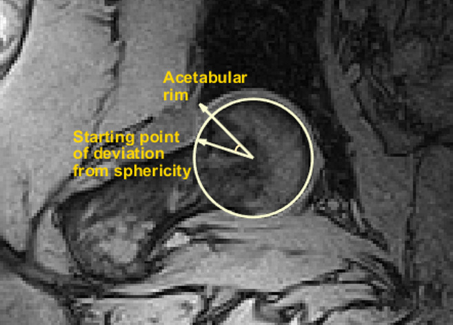 Fig. 1 
            Illustration of β angle in a control hip in the squatting posture in the α plane.
          