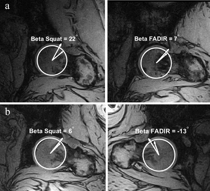 Fig. 3 
            Slices with the minimum β angle in the squatting and sitting flexion, adduction, and internal rotation postures in the MROpen for a) a control hip, and b) a cam and/or pincer morphology hip in the α plane.
          