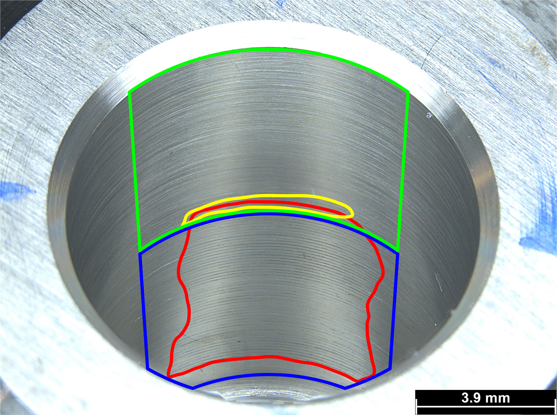 Fig. 6 
          Example fretting and corrosion damage area identification. A stereomicroscopic image is taken of the head taper’s medial aspect and proximal (blue) and distal (red) regions of interest are identified. Within the regions of interest, fretting (yellow) and corrosion (red) damaged regions are manually traced. Area of the traced regions are calculated using a standard software function (Adobe Illustrator, USA).
        