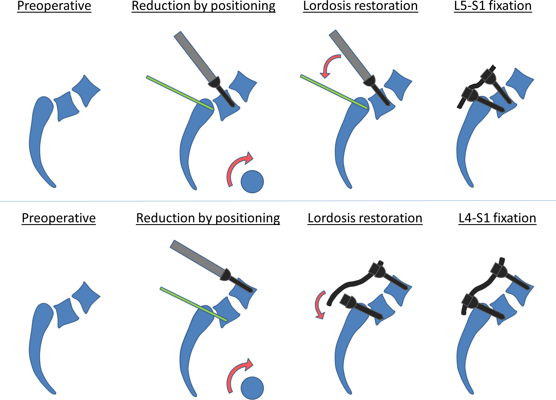 Fig. 1 
            Angular correction of lumbosacral kyphosis and improvement of the anterolisthesis of L5 over the sacrum by one Meyerding grade2 is mostly achieved through prone patient positioning over the Montreal mattress. Transfixation from S1 into L5 is supplemented by stabilization to L5 (top) or L4 (bottom) to allow lordosis restoration and a solid fusion with the use of iliac crest bone.
          