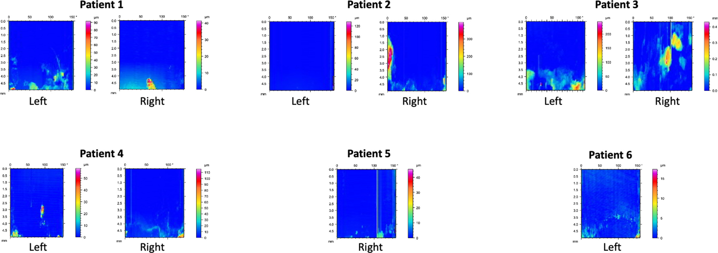 Fig. 9 
            Damage maps generated from line scans captured on each nail. The base of each map corresponds to the region adjacent to the point of contact between the housing tube and distraction rod.
          