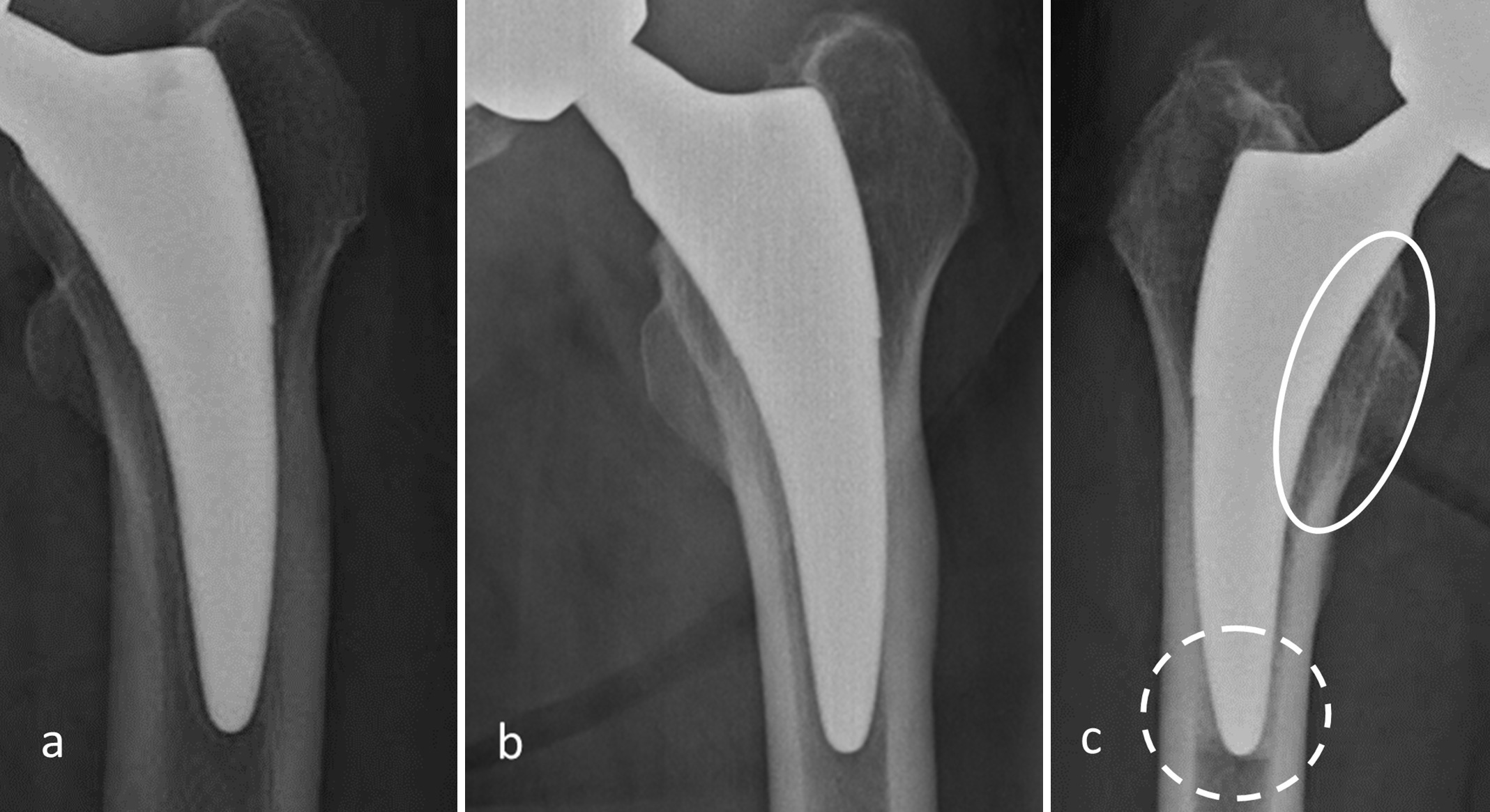 Fig. 2 
            Definition of each radiological finding: a) radiolucency on a 78-year-old female, b) cortical hypertrophy on a 72-year-old female, c) atrophy (circle with solid line), and bone condensation (circle with dotted line) on 64 years old female. All images were frontal view and taken at one year postoperatively.
          