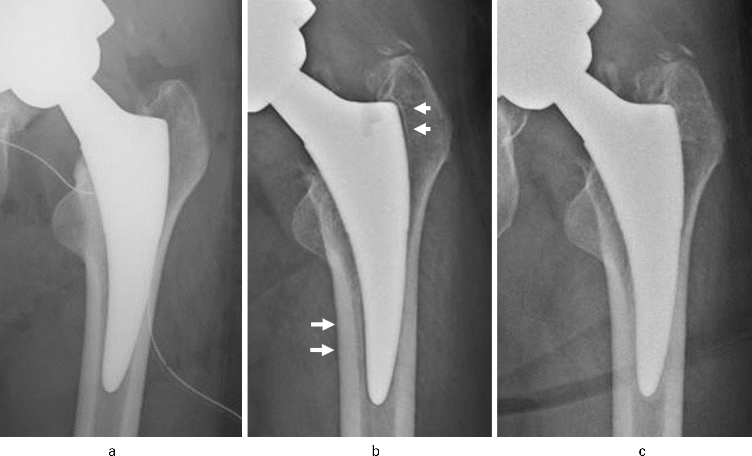 Fig. 3 
          Representative radiolucent line (RLL) case. a) Immediate postoperative radiograph. b) RLL is observed at Zone 1 and 5 at one year postoperatively. c) No RLL is observed at three years postoperatively. All images show frontal view of a 51-year-old female.
        