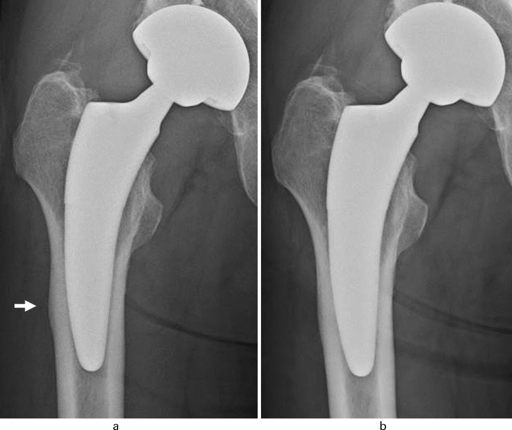 Fig. 5 
          Representative cortical hypertrophy (CH) case, frontal view of a 59-year-old male. a) More than 2 mm of radiological change is recognized as CH at one year postoperatively. b) Reduction of > 2 mm is classified as improvement at three years postoperatively.
        