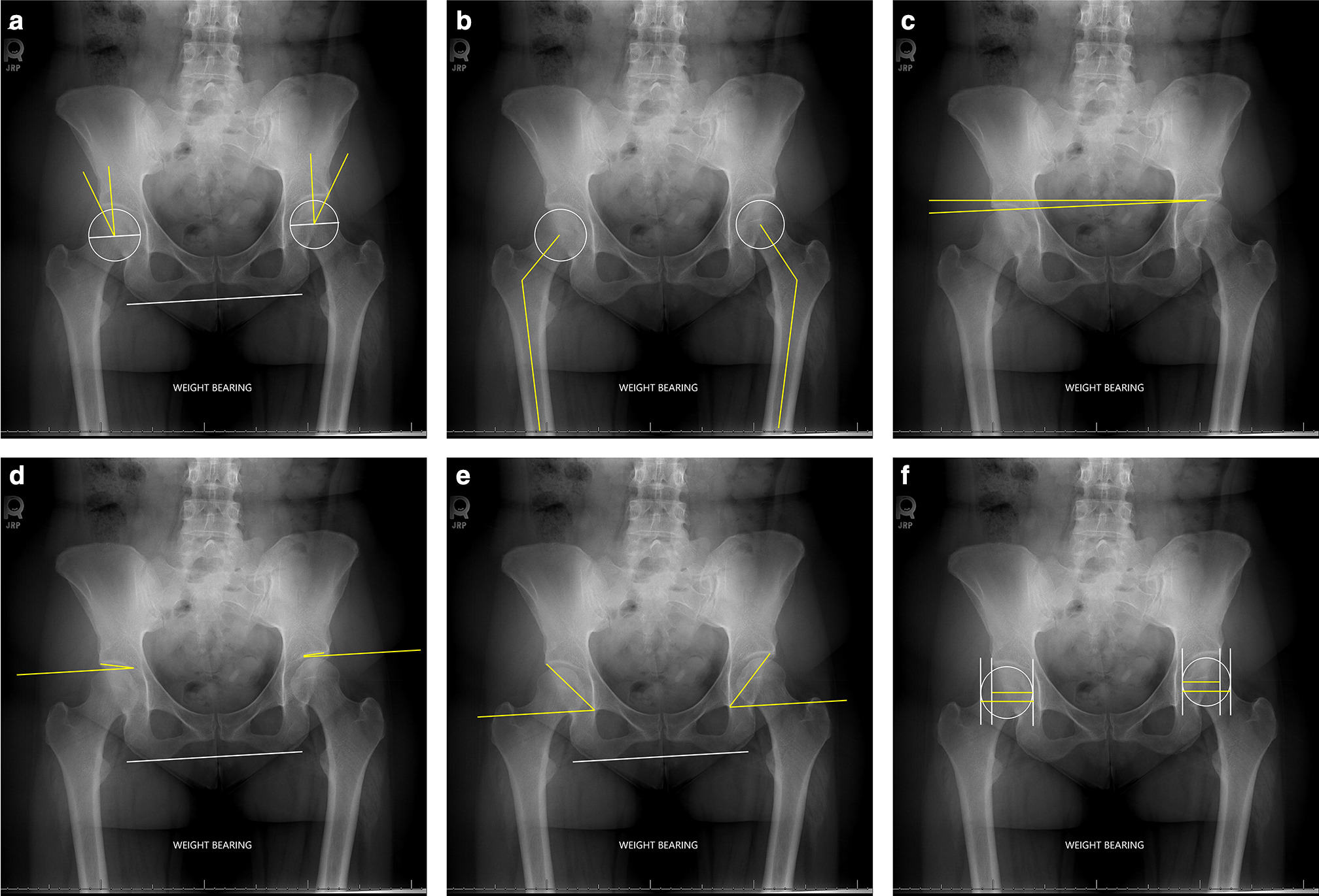 Fig. 2 
            Landmarks used by manual readers. a) Lateral centre-edge angle. b) Caput-collum-diaphyseal angle. c) Obliquity. d) Tönnis angle. e) Sharp’s angle. f) Femoral head coverage.
          