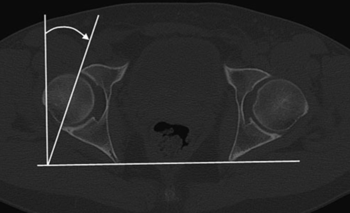 Fig. 1 
          Measurements of the central acetabular version, as published by Dandachli et al.26
        