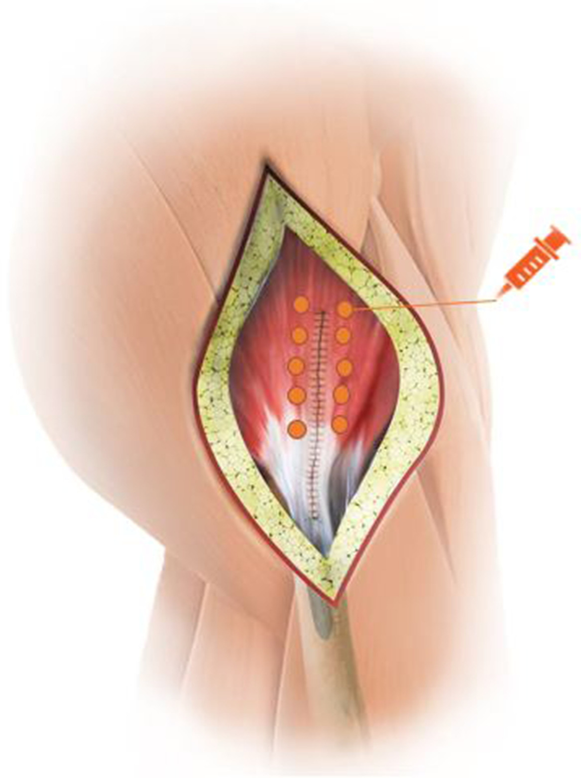 Fig. 2 
            The ten sites of injection after suture using the direct lateral approach.
          