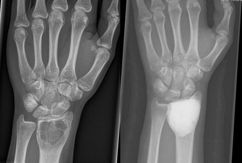 Fig. 1 
          35-year-old patient with conventional giant cell tumour of the distal radius, without cortical breakthrough nor soft-tissue extension. Treatment consisted of extended curettage with high-speed burring, phenol and filling of the remaining cavity with bone cement. There were no recurrences nor complications during follow-up.
        