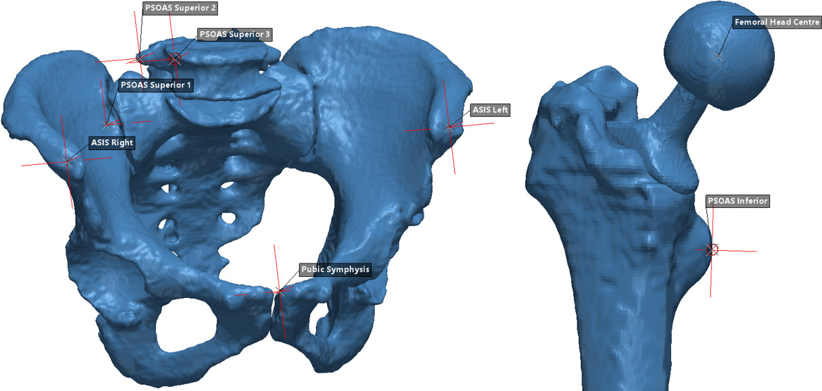 Fig. 2 
            Illustration of the landmarks taken for the simulation. The anterior superior iliac spine (ASIS) points and pubic symphysis form the anterior pelvic plane (APP) and allow calculation of the supine pelvic tilt. Psoas Superior 1 to 3 and Psoas Inferior represent the ‘attachment sites’ of the iliopsoas. The femoral head centre was used as the point at which the pelvis rotates around.
          