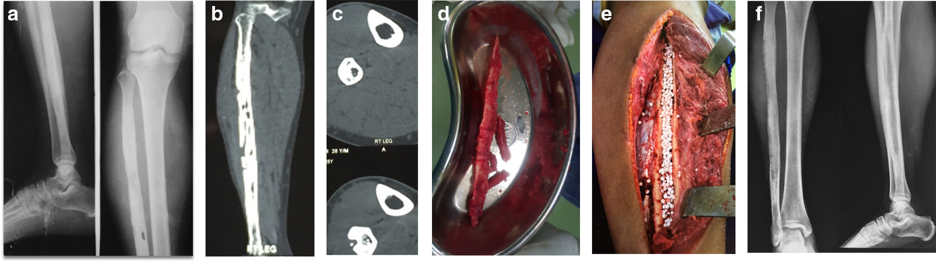 Fig. 1 
            a) 28-year-old male with fibular osteomyelitis. Anteroposterior (AP) and lateral views demonstrating diaphyseal radiolucent lesion in the shaft and sclerosis of entire fibula. b) Coronal CT section demonstrating multiple radiolucent lesions and sclerosis of entire fibula suggestive of extensive fibular osteomyelitis. c) Axial CT sections demonstrating fibular osteomyelitis with sequestrum and cortical defect. d) Intraoperative picture of sequestrum removed from fibula. e) Intraoperative picture following sequestrectomy and saucerization of fibular osteomyelitis and Stimulan insertion. f) Follow-up radiograph, with AP and lateral views demonstrating good healing.
          