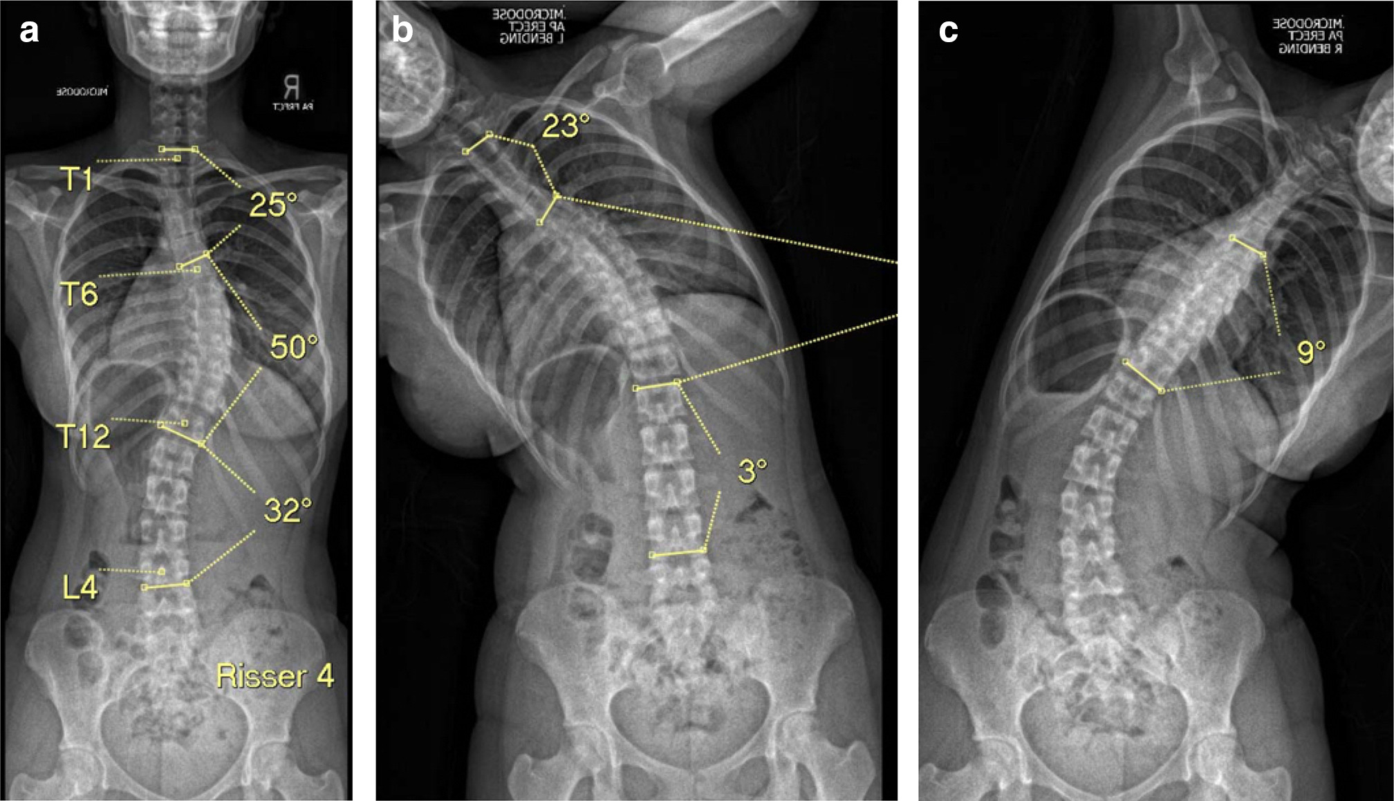 Fig. 3 
            a) Erect radiograph (for surveys 1, 2, and 4). b) Suboptimal left bending radiograph. c) Optimal right bending radiograph.
          