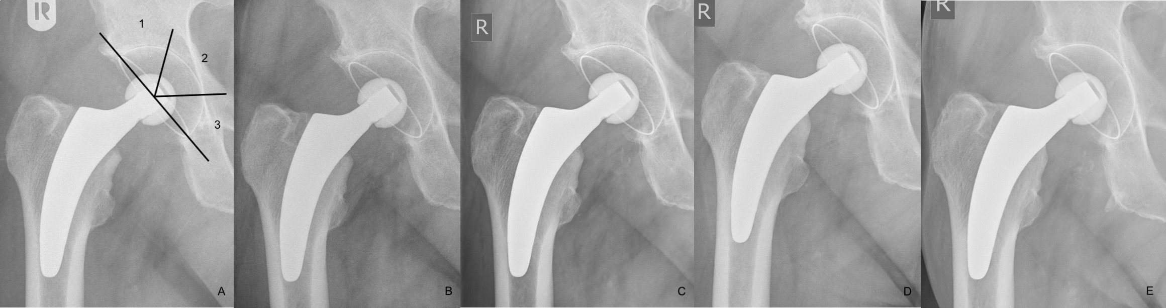 Fig. 2 
          Radiographs of 53-year-old male patient with signs of a lucent line. a) Immediately postoperation with DeLee and Charnley zones, b) six weeks postoperatively, c) follow-up at one year, d) five years, and e) ten years.
        