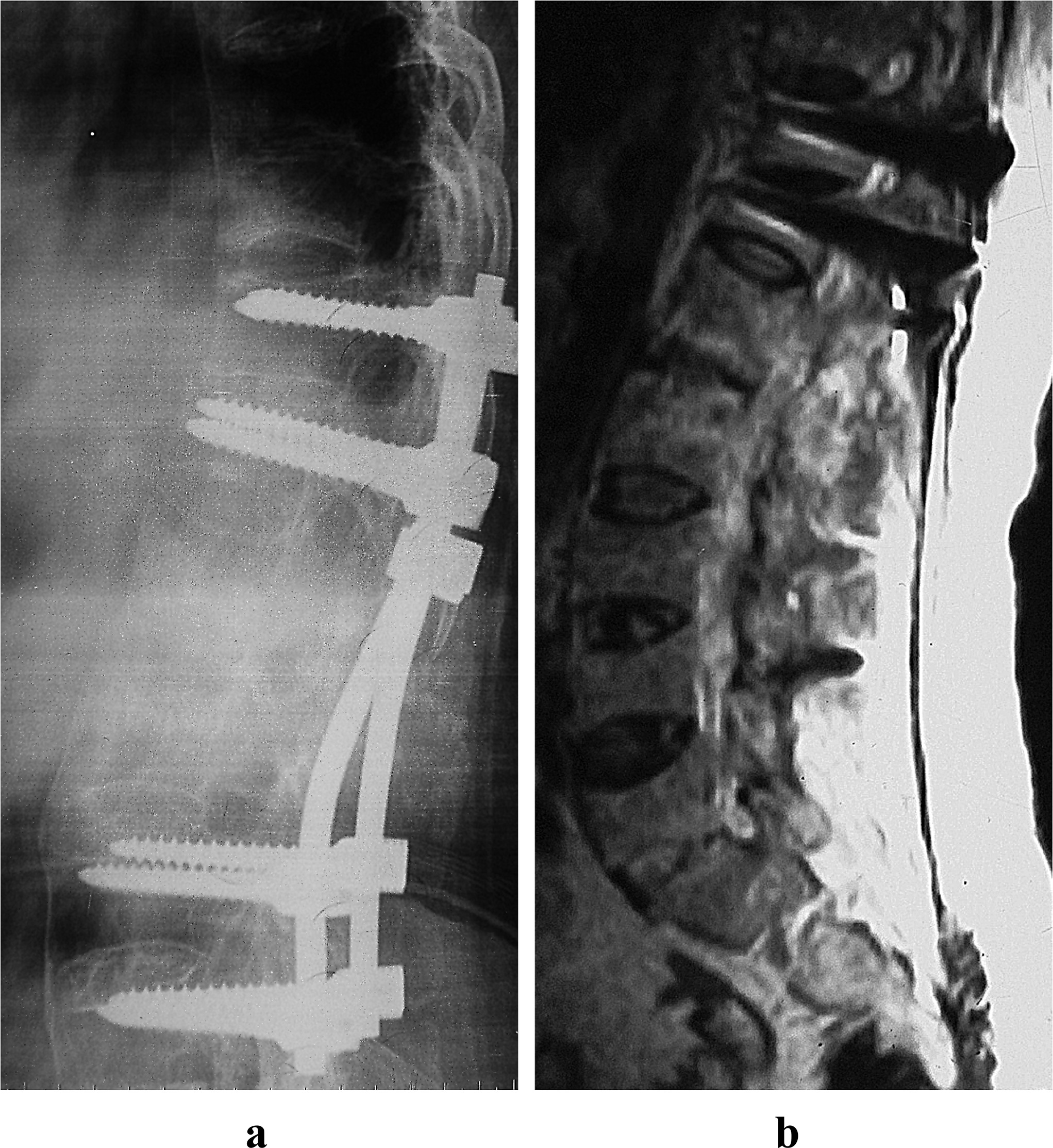 Fig. 2 
            The same patient as shown in Figure 1. a) The anterior lesion is healed on the on the lateral radiograph film at two-year follow-up. b) MRI of six-year follow-up showed the anterior lesion remained healed with no complications.
          