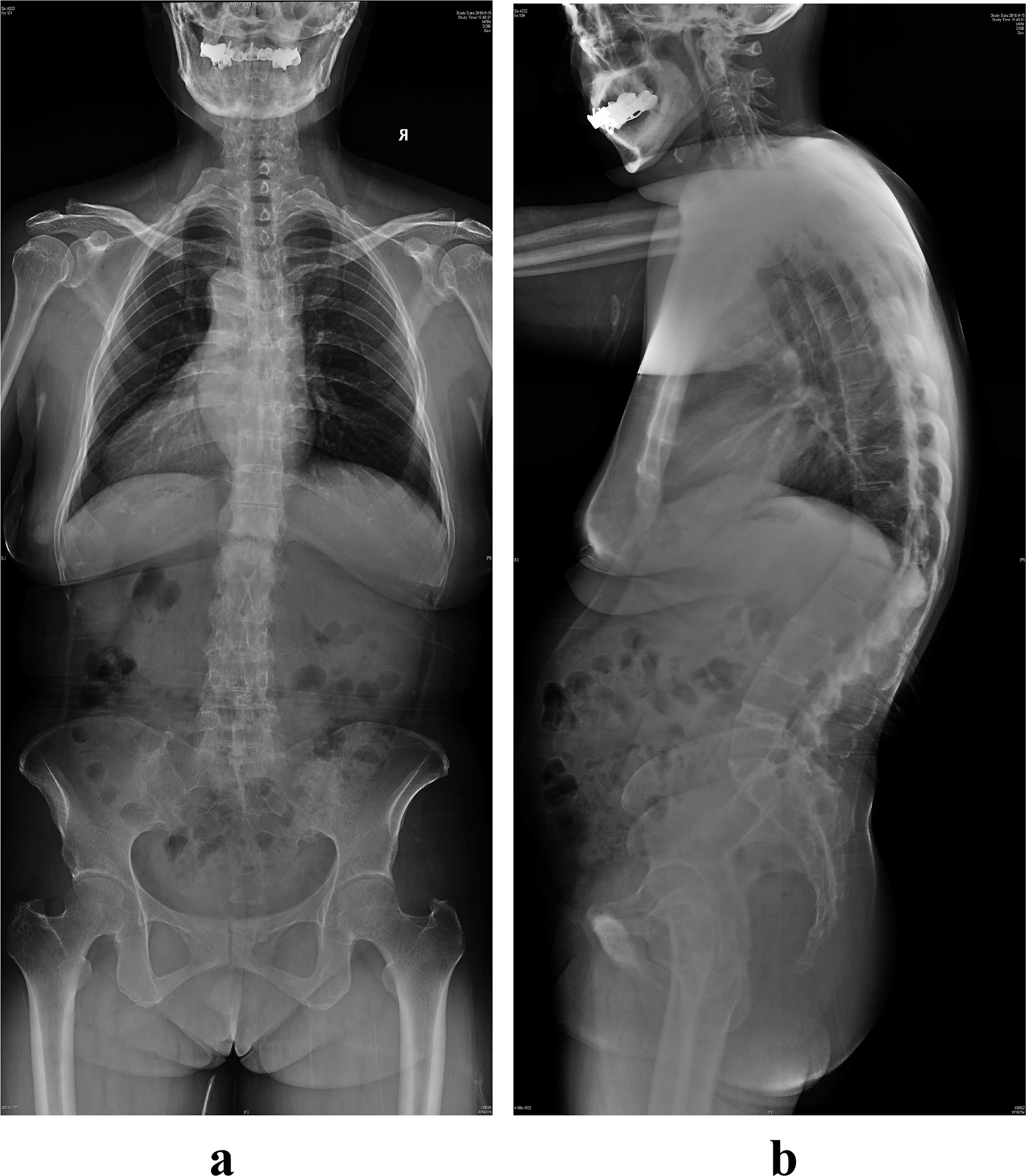 Fig. 3 
            a) Preoperative anteroposterior and b) lateral radiographs of a 56-year-old female patient from the minimally invasive surgery group who had an Andersson lesion at T12/L1. There is a 31° local kyphosis.
          