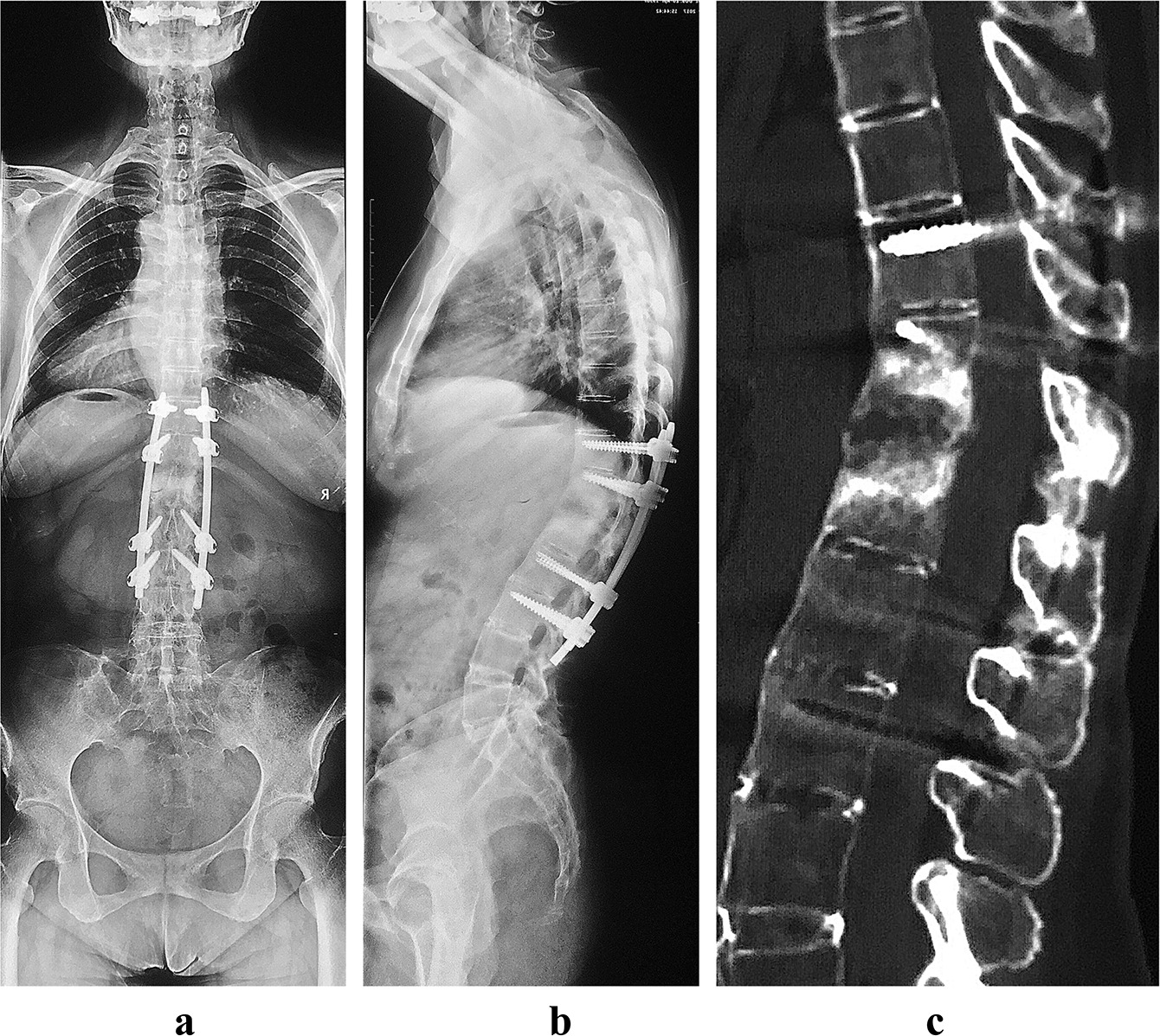 Fig. 4 
            a) Anteroposterior and b) lateral radiographs at the final one-year follow-up showed nonunion or pseudoarthrosis. c) The anterior lesion is united on the CT at the final follow-up.
          