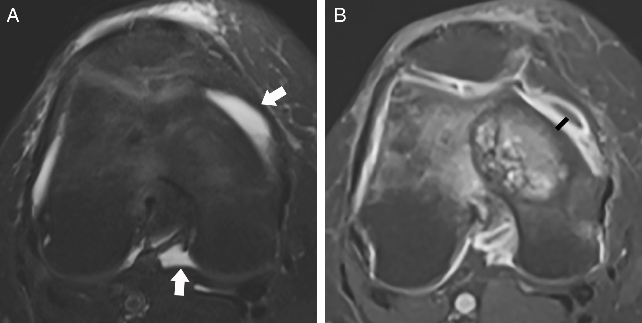 Fig. 2 
            Case example of MRI assessment of a knee with tumour invasion. A 58-year-old female presented with left distal femur osteosarcoma and intra-articular extension on pathology. a) Axial T2FS image shows grade 1 knee joint effusion (arrows) in the medial patellofemoral recess and posterior to posterior cruciate ligament. b) Axial T1FS postcontrast shows grade 2 synovial thickening (line) measuring 3 mm in the medial patellofemoral recess.
          