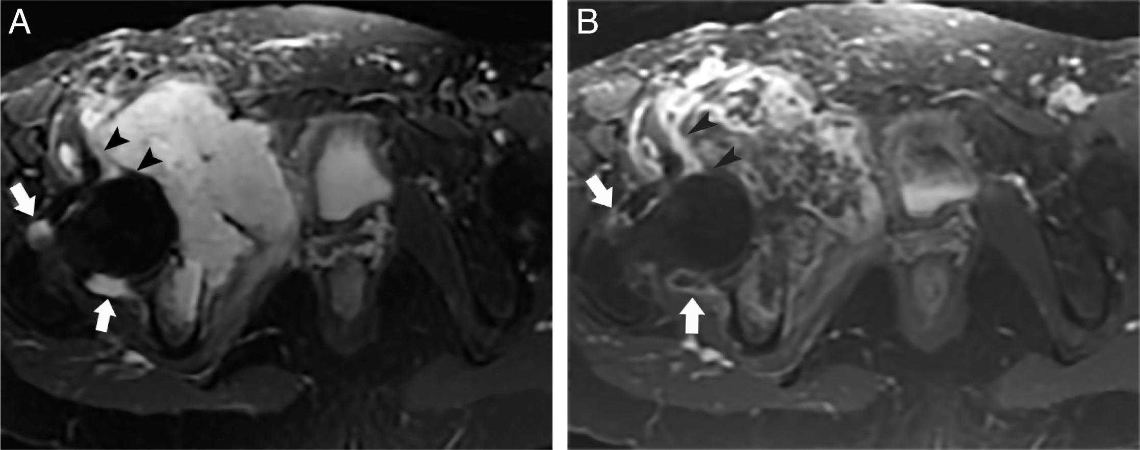 Fig. 3 
            Case example of MRI assessment of a hip with tumour invasion. A 64-year-old female presented with right acetabular chondrosarcoma and intra-articular extension on pathology. a) Axial T2FS image shows grade 2 hip joint effusion anterior and posterior to femoral head-neck junction (white arrows). b) Axial T1FS postcontrast image shows grade 2 synovial thickness (arrows) and tumour invasion manifested by cortical and cartilage bone destruction (black arrowheads).
          