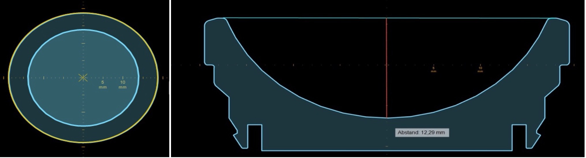 Fig. 2 
          Screenshot of a measurement on mediCAD 3D shoulder. Left: axial view; the liner is positioned strictly parallel to the axial plane; the centre of the liners’ concavity is determined by using a best-fit circle. Right: frontal view; first a tangential line is drawn on top of the concavity (blue line). Then, the jump height is determined by drawing an orthogonal line (red) from the middle to the bottom of the concavity.
        