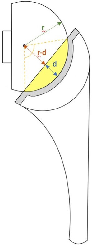 Fig. 3 
            Illustration of a reverse total shoulder arthroplasty: radius (r) of the glenosphere and concavity depth (d) or jump height of the liner are required to calculate the liner stability ratio (LSR) using the aforementioned formula. Yellow area: the extent of the glenosphere covered by the liner; yellow striped line: angle of coverage (degree of glenosphere coverage by the liner).
          