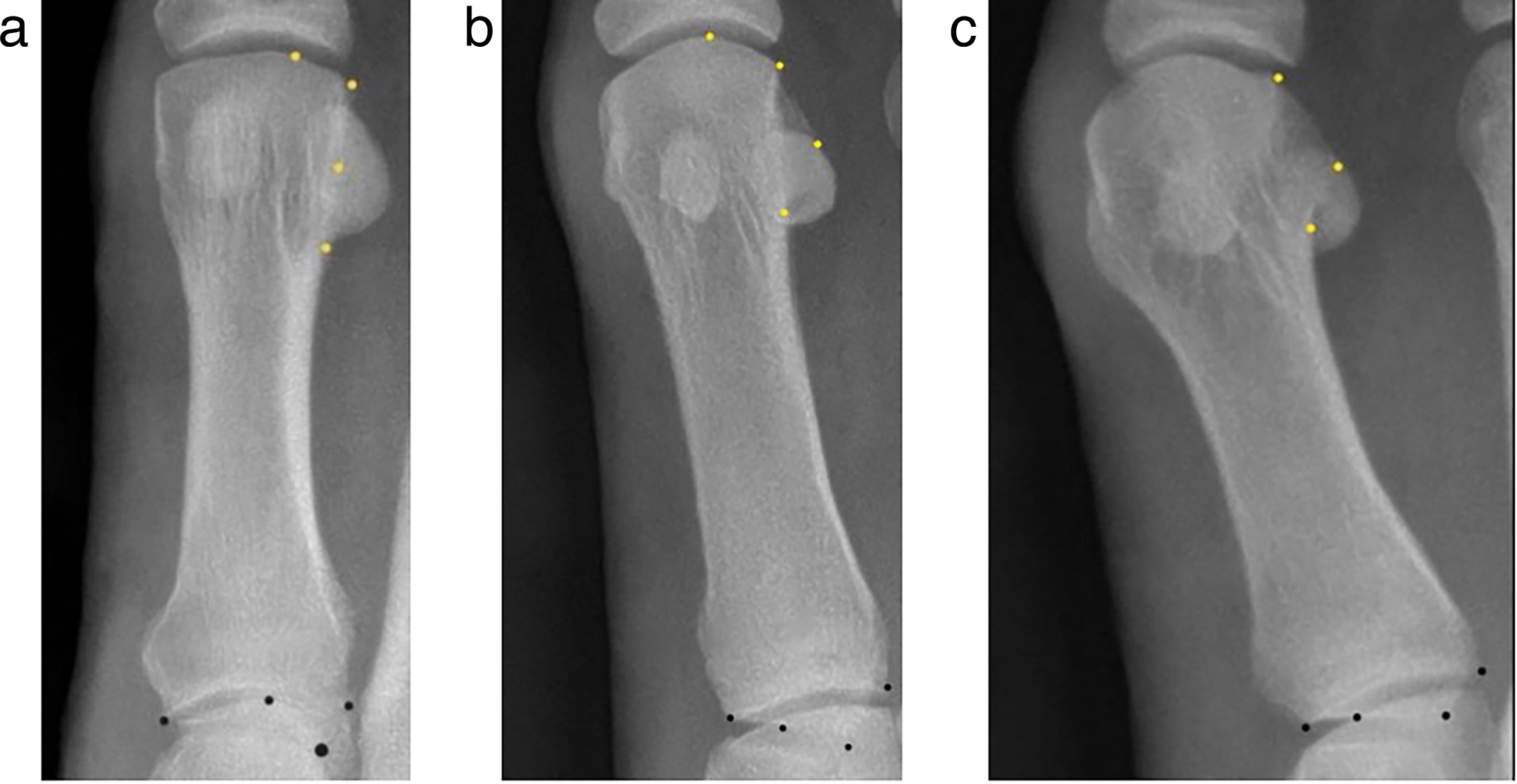 Fig. 1 
          Standing anteroposterior view of the first metatarsal round head sign in a 47-year-old female. a) Angular. b) Intermediate. c) Round.
        