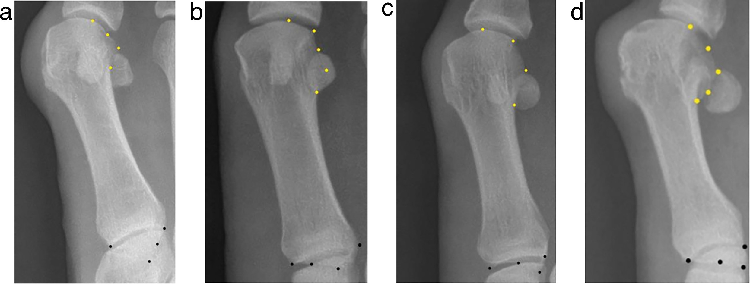 Fig. 2 
          Standing anteroposterior view of the first metatarsal inferior tuberosity position sign in a 55-year-old female: a) 0°, b) 10°, c) 20°, and d) 30°.
        