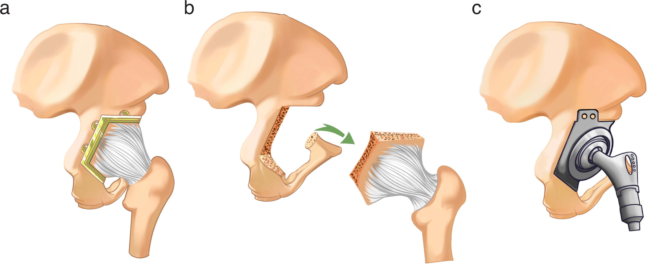 Fig. 1 
            a) A posterolateral incision was made to expose the posterior column of the acetabulum, ischial ramus, and acetabulum. An osteotomy guide plate was placed for excision. b) After osteotomy with an oscillating saw, the hip joint was removed together with the femoral segment and the acetabulum, but the continuity of the joint capsule was preserved. c) Customized acetabular component and modular femoral component were placed for reconstruction.
          