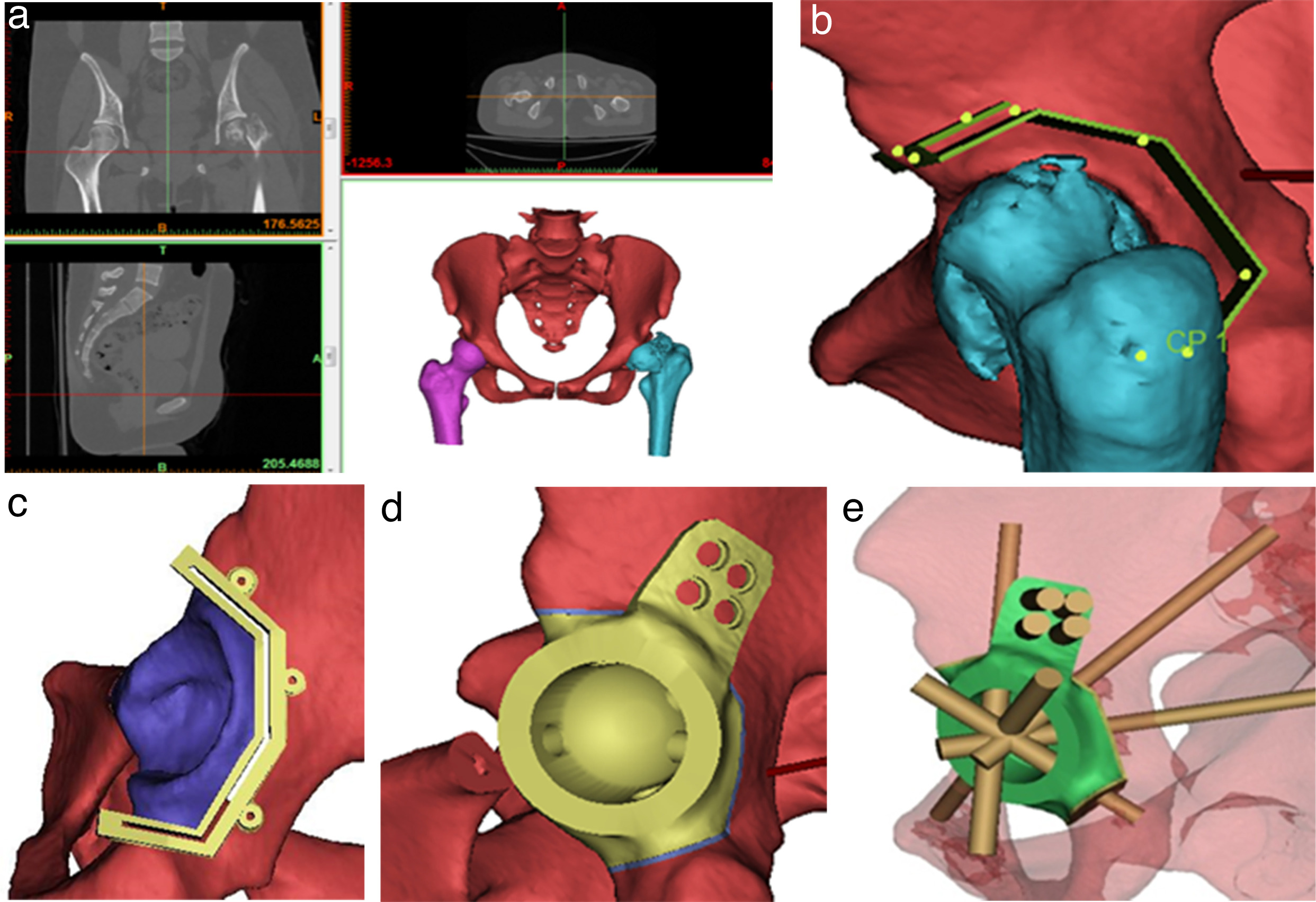 Fig. 2 
            Preoperative design process for osteotomy guide and prosthetic component for bony fixation. a) Model reconstruction is based on thin-sliced CT. b) Surgical resection range is constructed on 3D digital software after communication and consensus between the surgeons and engineers. c) Guide plate design is completed. d) Prosthetic component design for bony fixation is based on the resection planes. e) The number, length, and trajectory of the screws are determined.
          