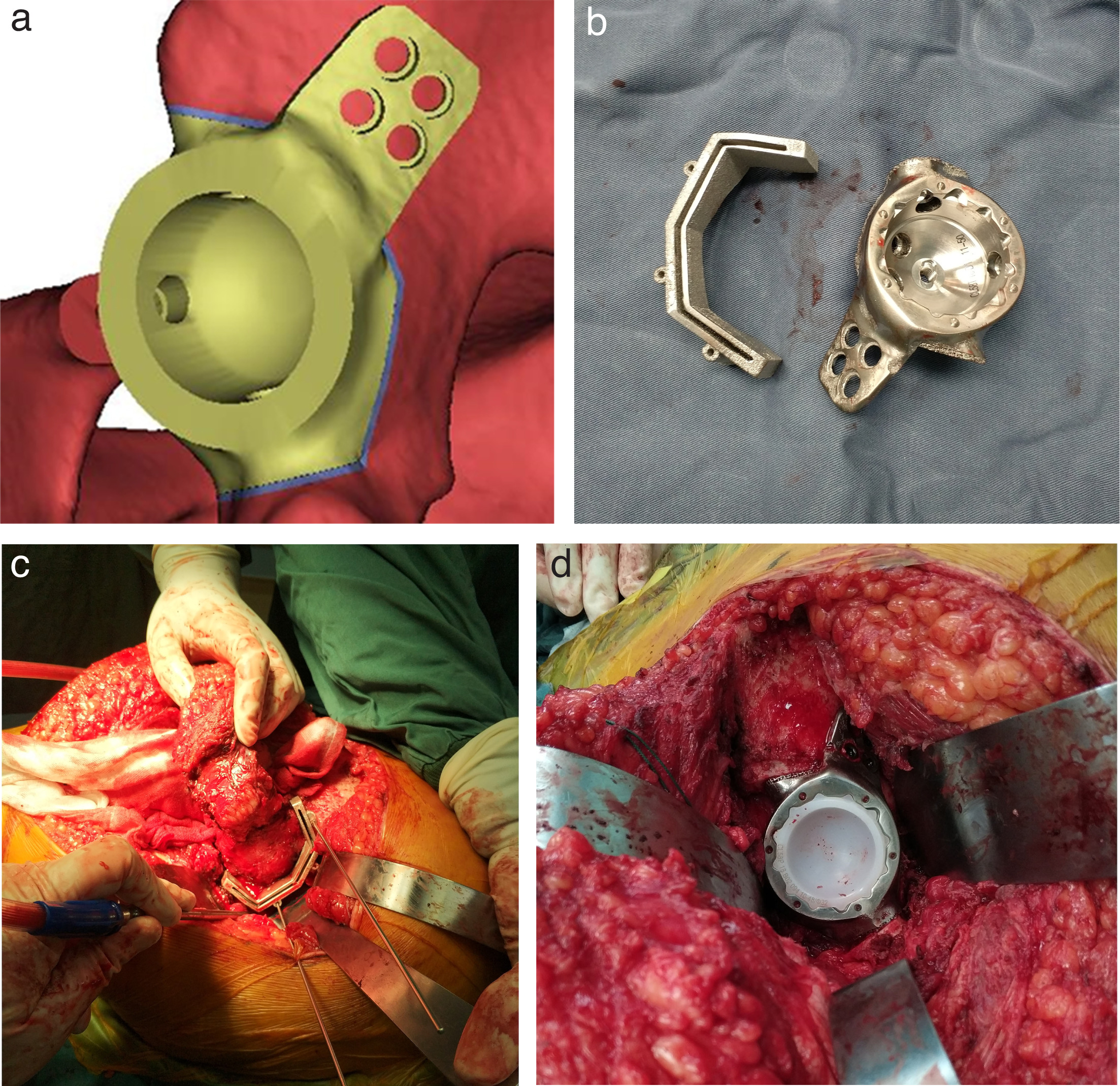 Fig. 3 
            Preoperative endoprosthesis design and perioperative endoprosthesis placement. a) Computer-simulated osteotomy plate and acetabular component. b) The 3D-printed plate and acetabular component were prepared. c) The osteotomy plate was placed during surgery. d) There was a complete match of the acetabular component.
          