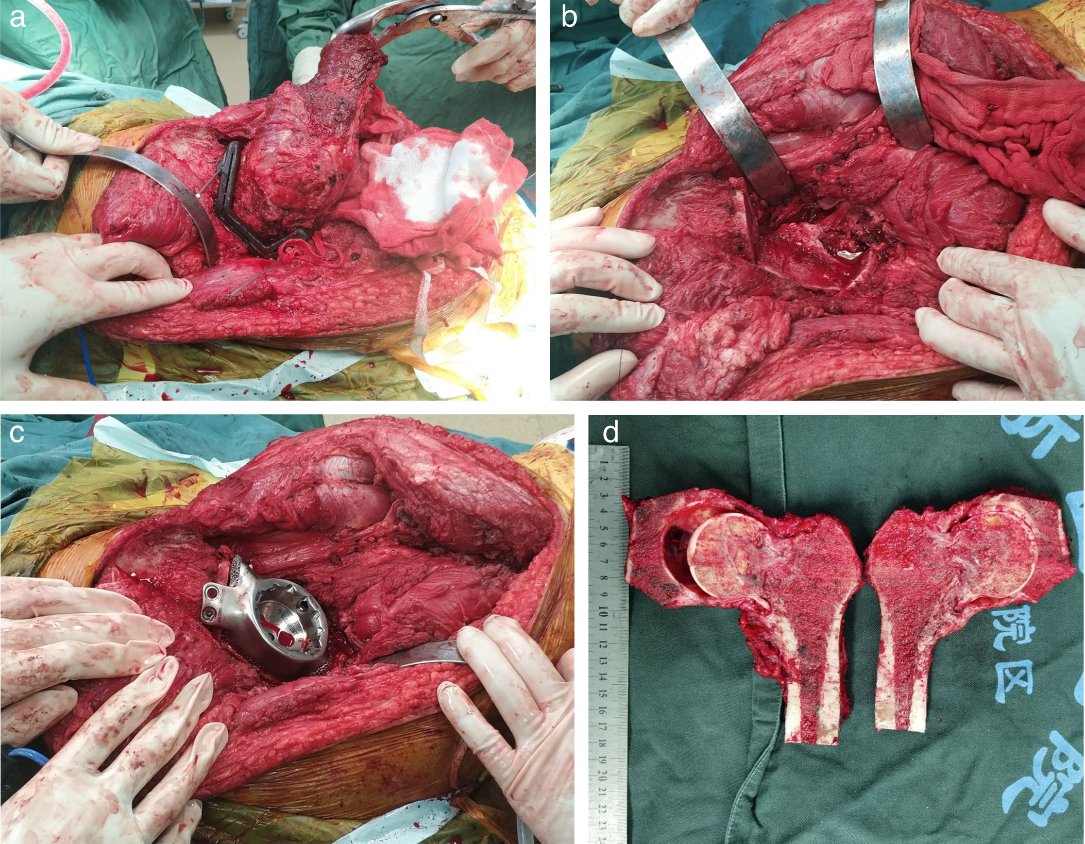 Fig. 4 
            Surgical procedure. a) After the ischial ramus and ischial tuberosity were exposed, the guide plate was placed. b) The tumour was removed with the hip joint using the oscillating saw. c) The acetabular component was placed with three surfaces attached to osteotomy surface. d) The joint capsule remained intact based on the coronal section of the tumour.
          