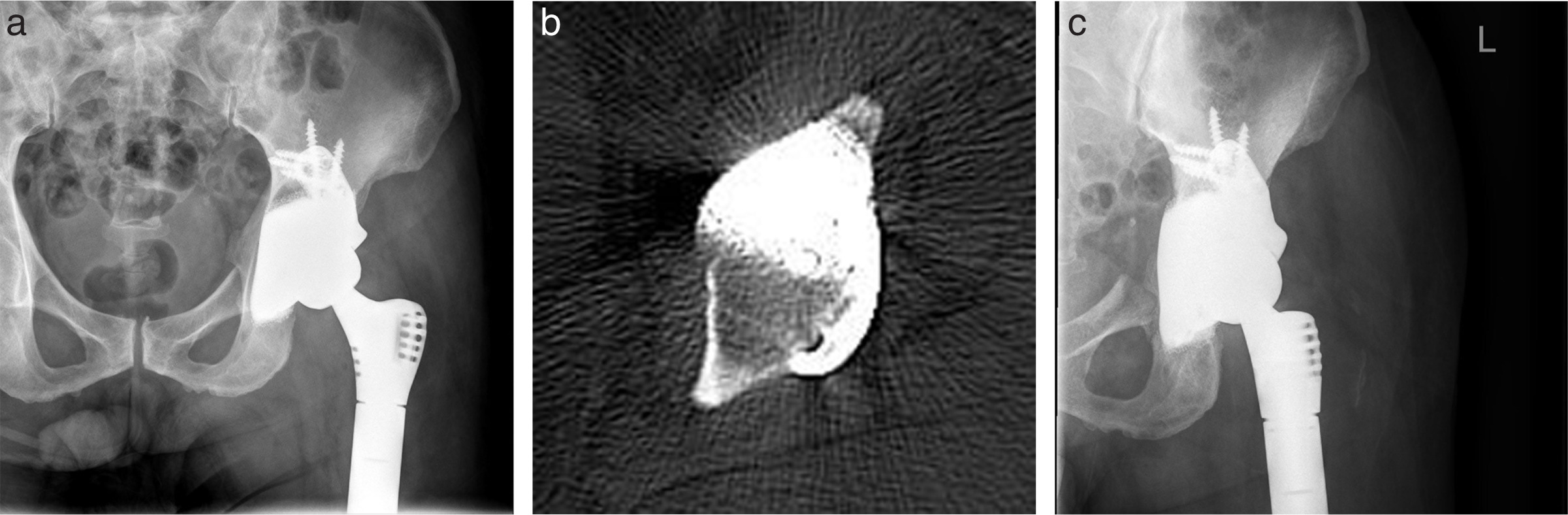 Fig. 8 
            a) Postoperative anteroposterior (AP) radiograph of a 54-year-old male patient who presented to our hospital with femoral osteosarcoma, taken six months after surgery. The prosthesis was restored to its anatomical position. b) Transverse CT scan taken two years after surgery. The CT scans demonstrated a good integration between the prosthesis and the surrounding bone tissue, and no radiolucent lines were observed. c) AP radiograph taken two years after surgery. The prosthesis was restored to its anatomical position and displays a good and stable fit.
          