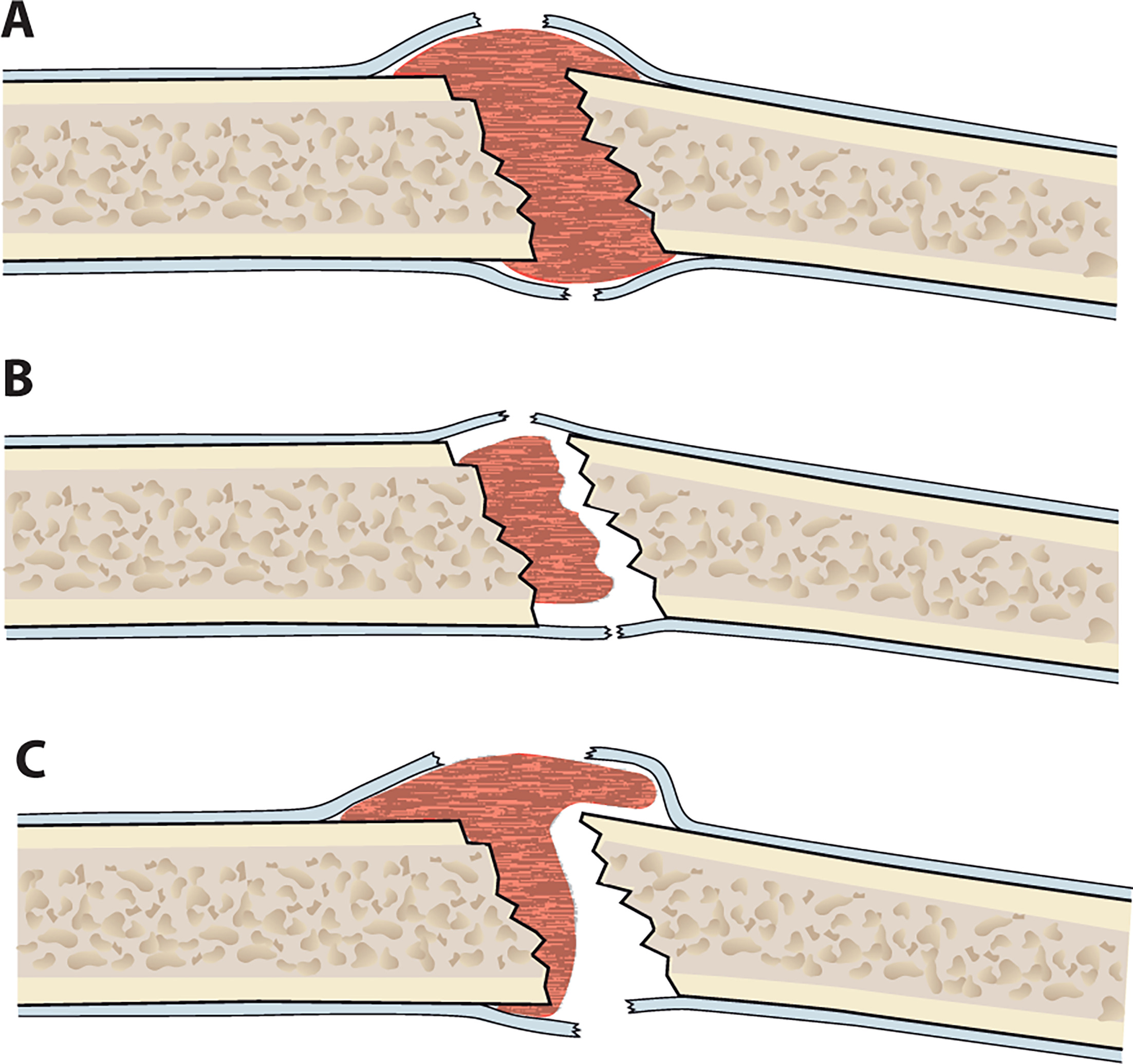 Fig. 2 
            Illustration of (A) bridging callus on both cortices, (B) non-bridging callus on both cortices, and (C) our intermediate form “M” for Maybe on the upper cortices, where callus extends beyond a virtual line drawn between proximal and distal cortices and callus envelopes the exposed cortices, but the callus is not bridging, and non-bridging callus on the lower cortices.
          