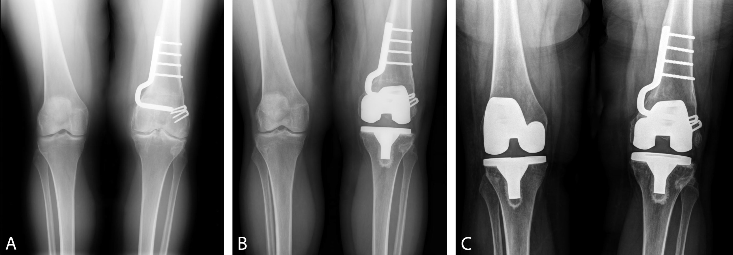 Fig. 2 
          Anteroposterior radiographs of a 48-year-old female with a) a valgus deformity of the left knee treated with a medial closing-wedge distal femoral osteotomy with plate and screws and a staple for femoral fixation. b) Subsequently after 15.2 years, the left knee underwent conversion to total knee arthroplasty (TKA). c) Finally, the right knee, without any prior knee osteotomy, underwent primary TKA 10.4 years after prior contralateral TKA.
        